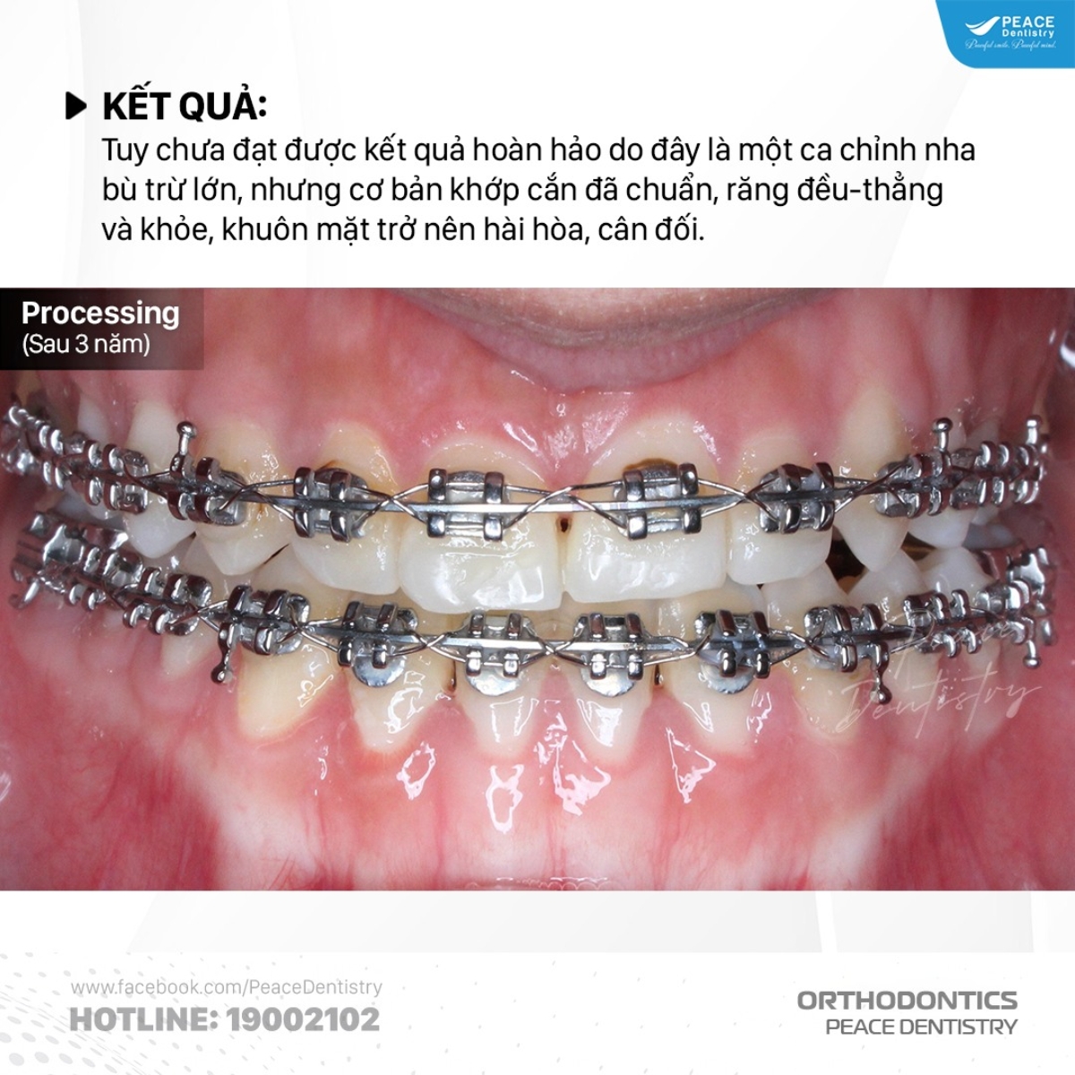 hình ảnh sau khi điều trị