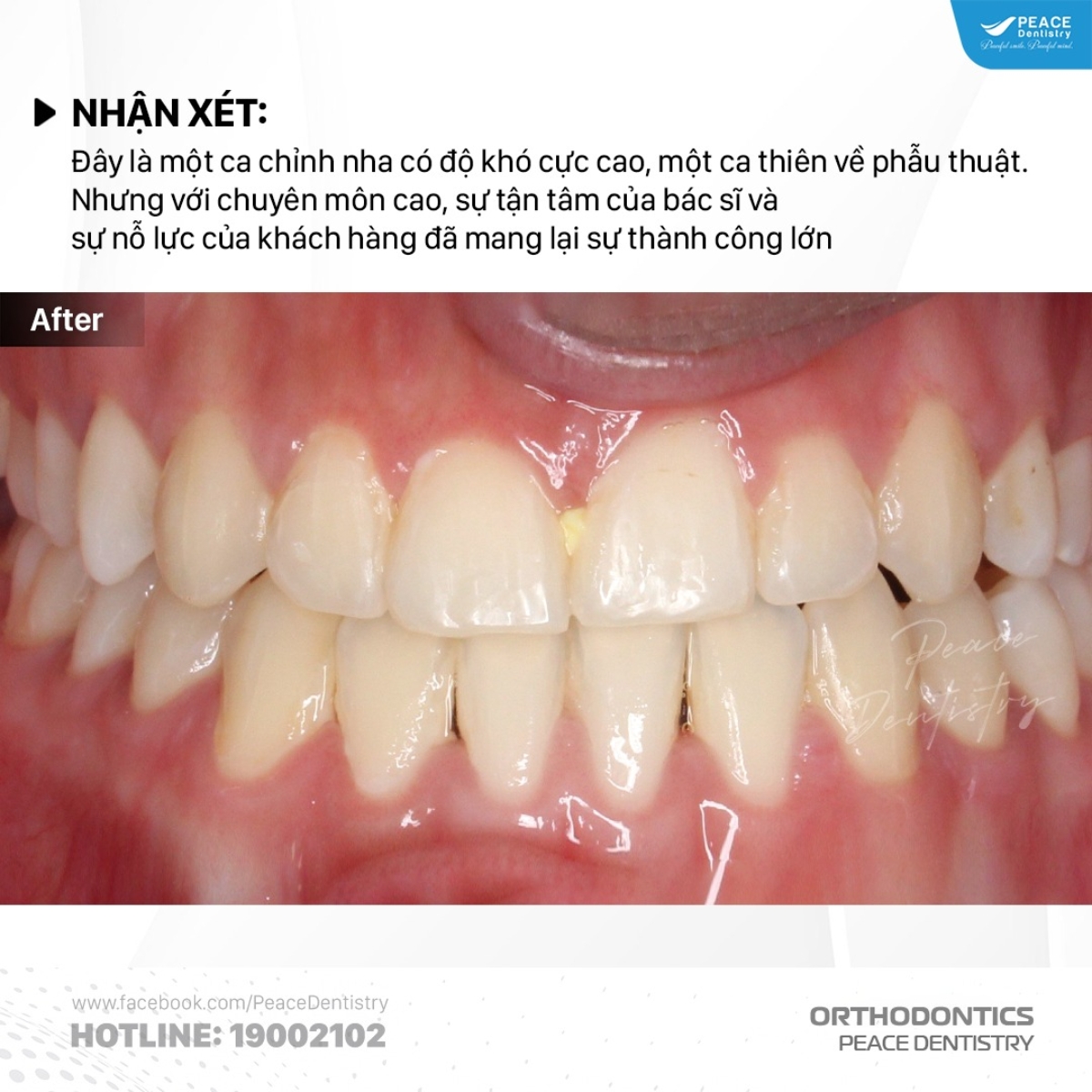 kết quả sau khi điều trị