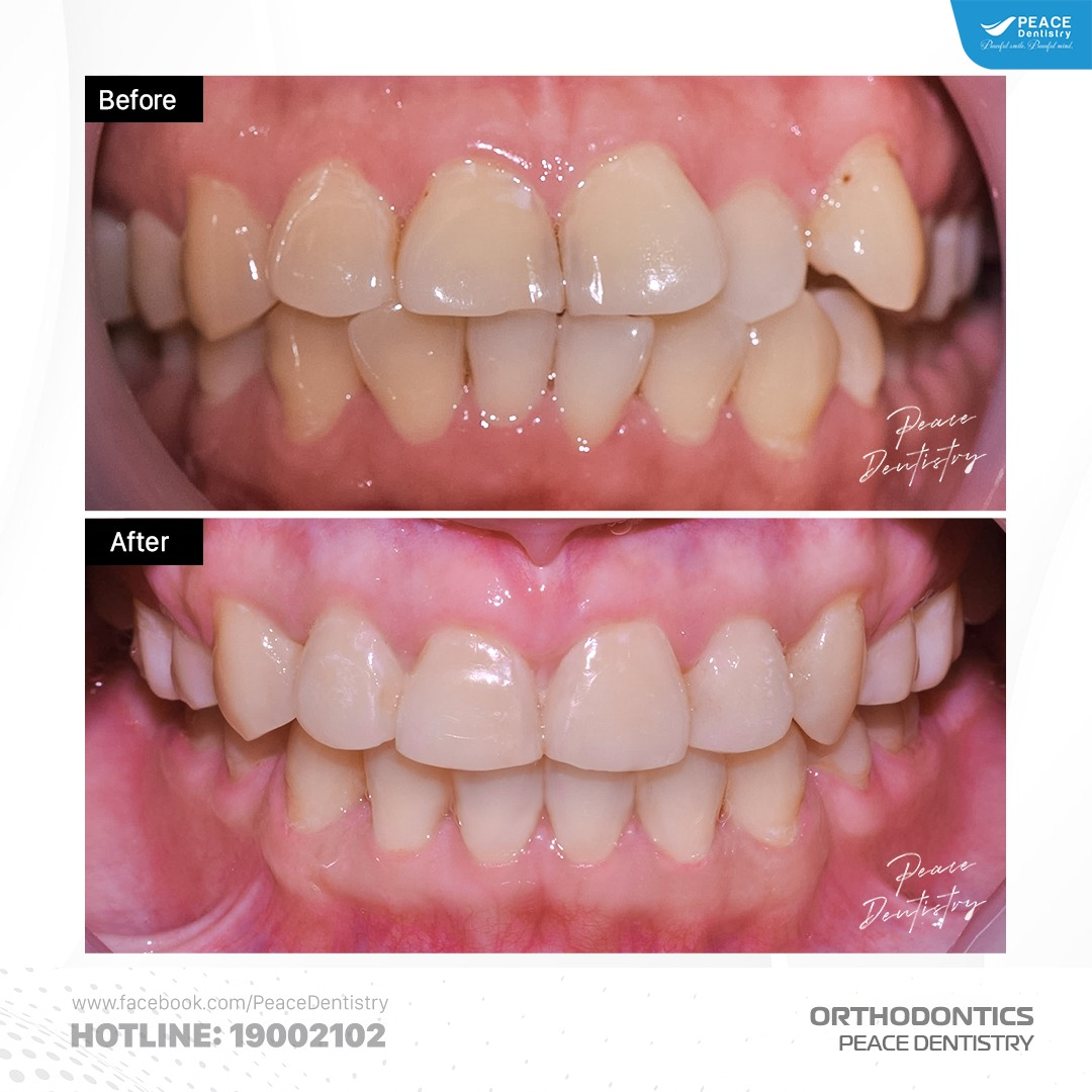 case mang thai khi niềng răng tại peace dentistry 1