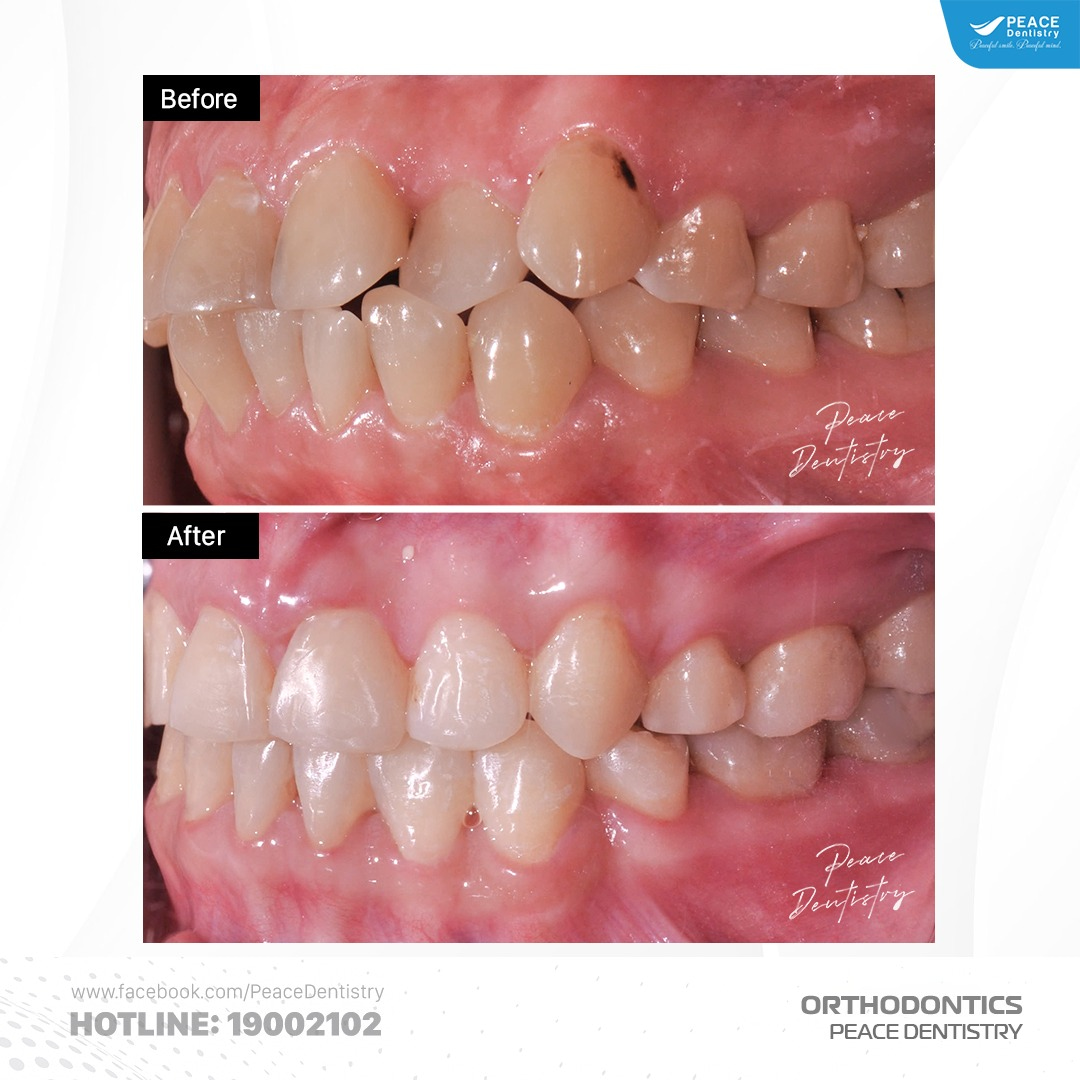 case mang thai khi niềng răng tại peace dentistry 2