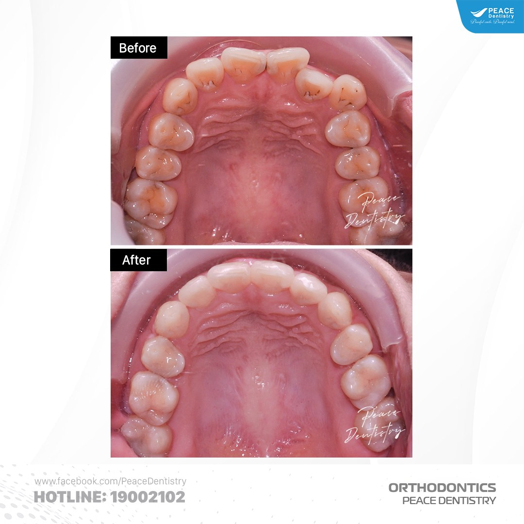 case mang thai khi niềng răng tại peace dentistry 3
