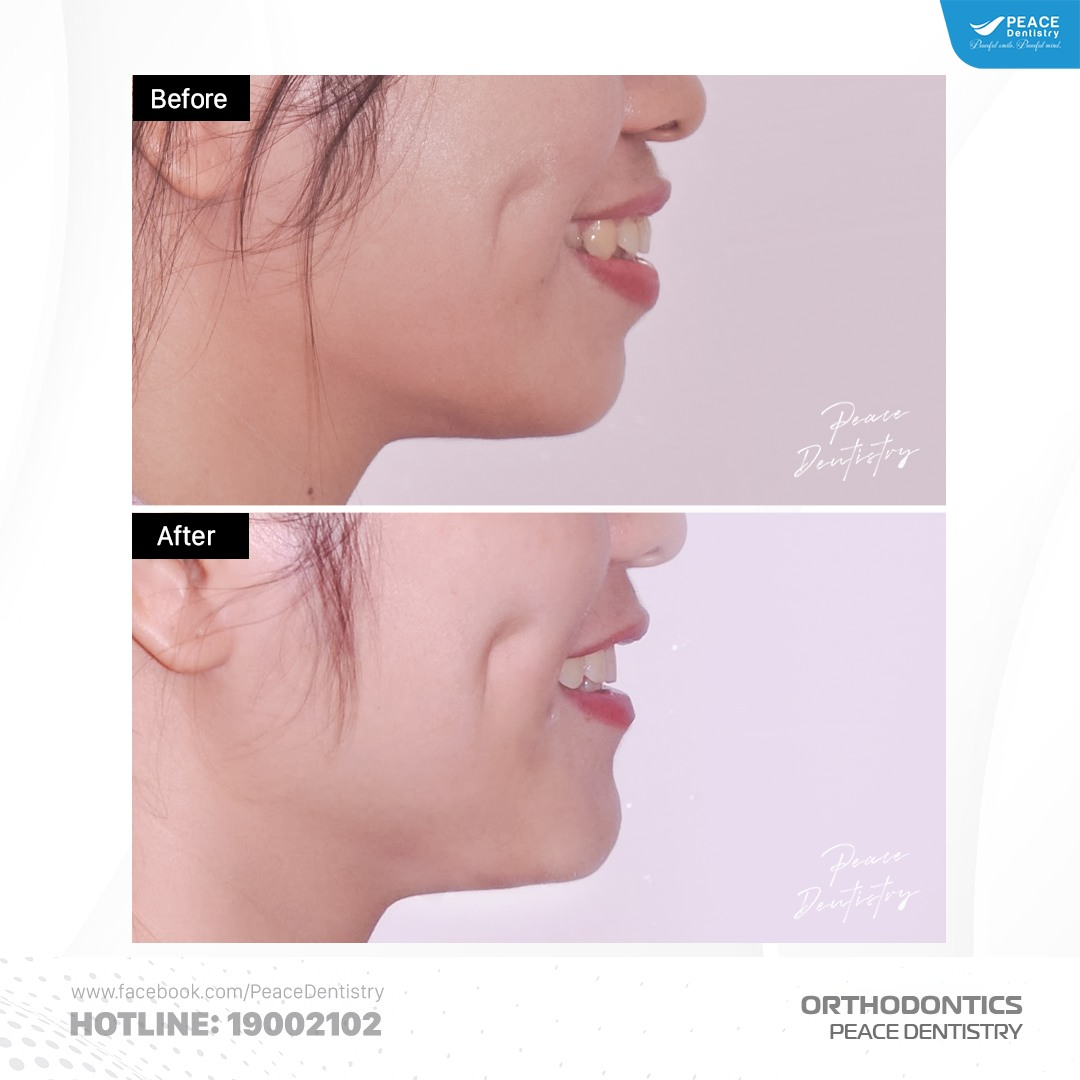 case mang thai khi niềng răng tại peace dentistry 4