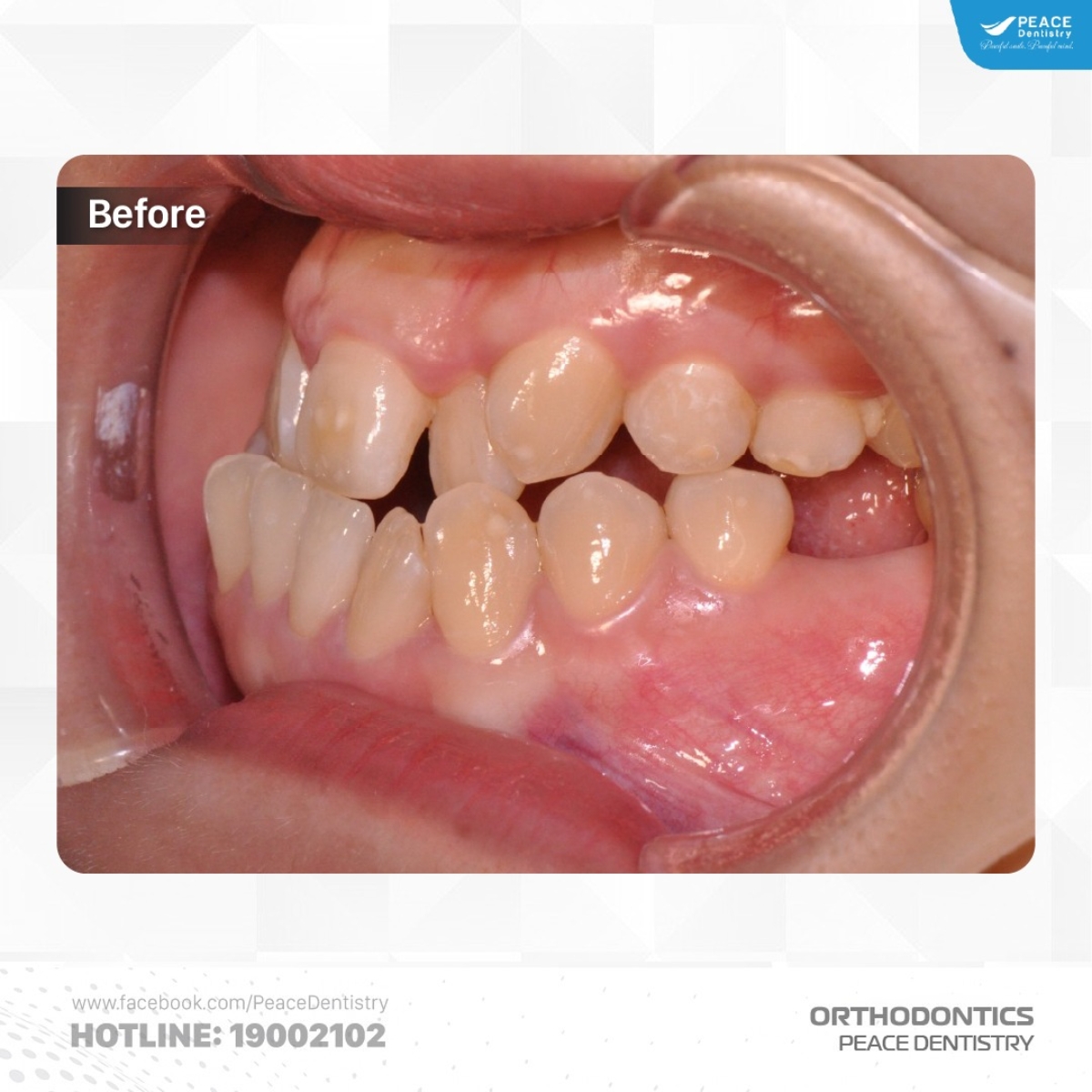 sai khớp cắn hạng 3 răng chen chúc cắn ngược