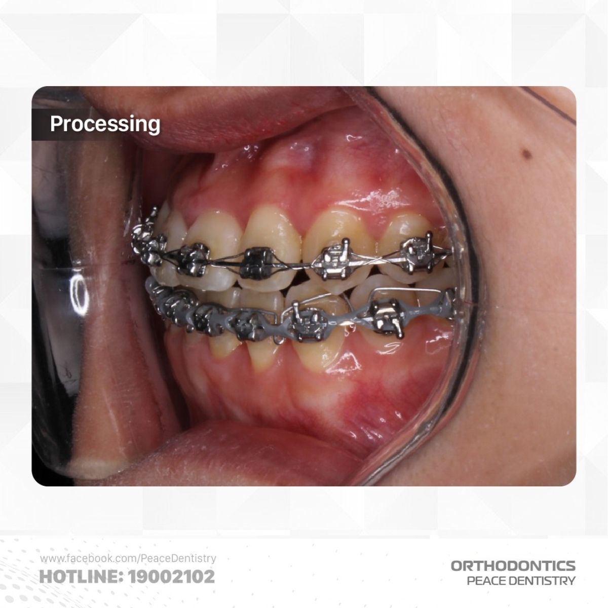 điều chỉnh khớp cắn nong rộng cung hàm trên