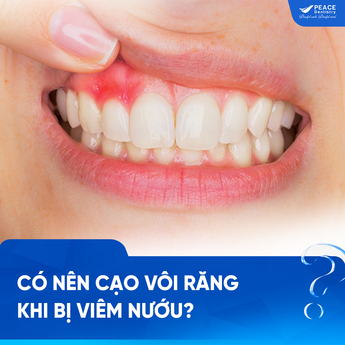 có nên cạo vôi răng khi bị viêm nướu