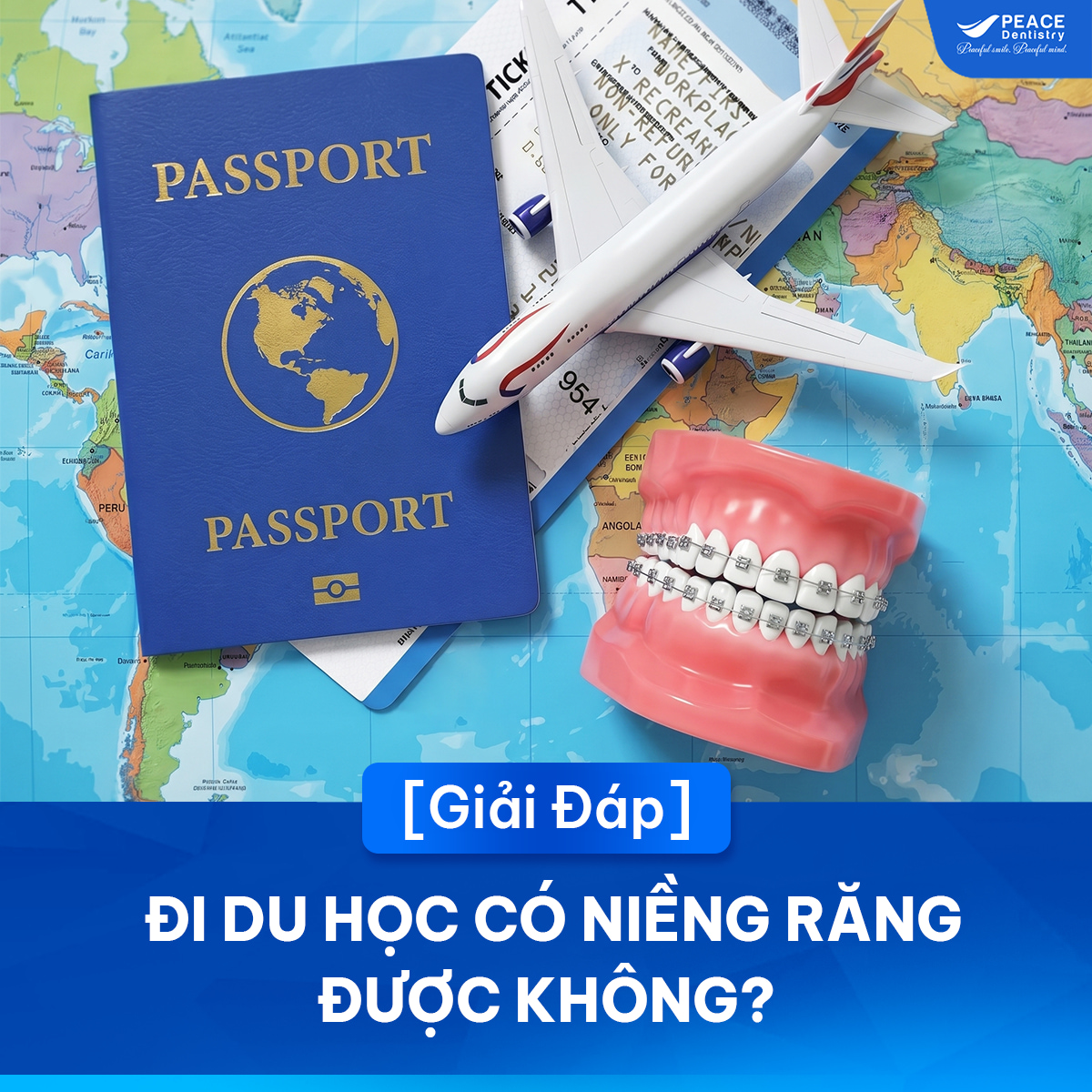 đang niềng răng có đi du học được không