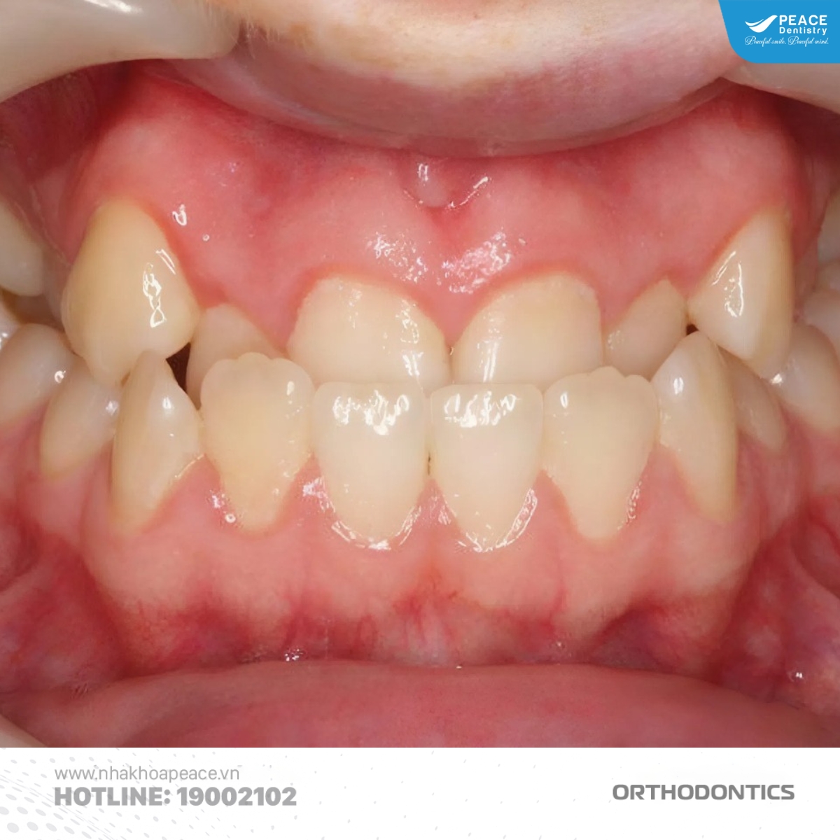 dấu hiệu nhận biết niềng răng xong bị móm