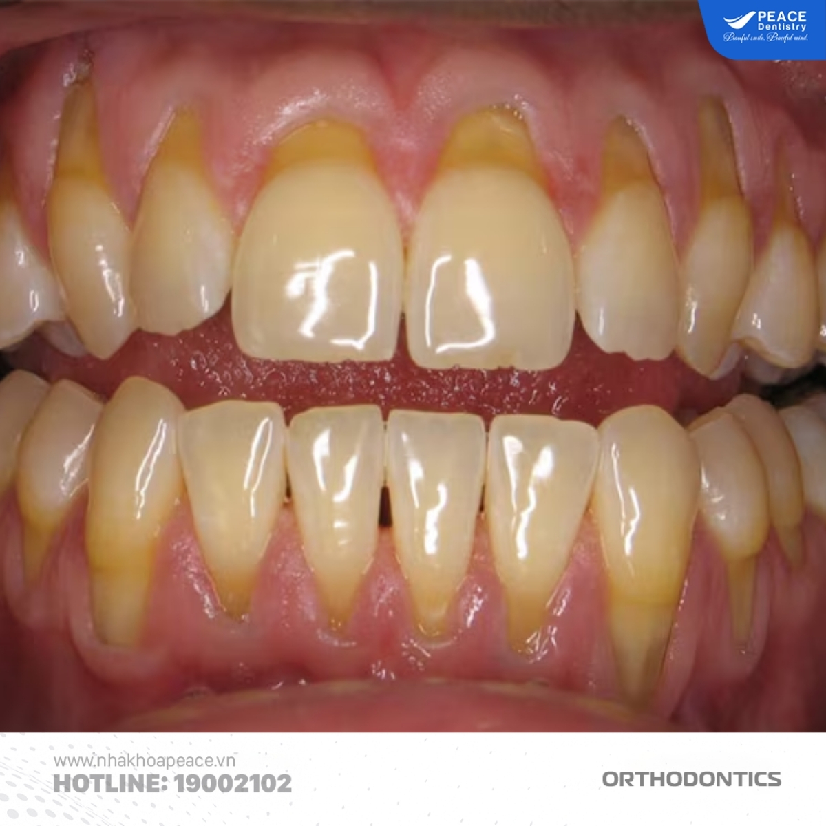 dấu hiệu nhận biết tụt lợi khi niềng răng