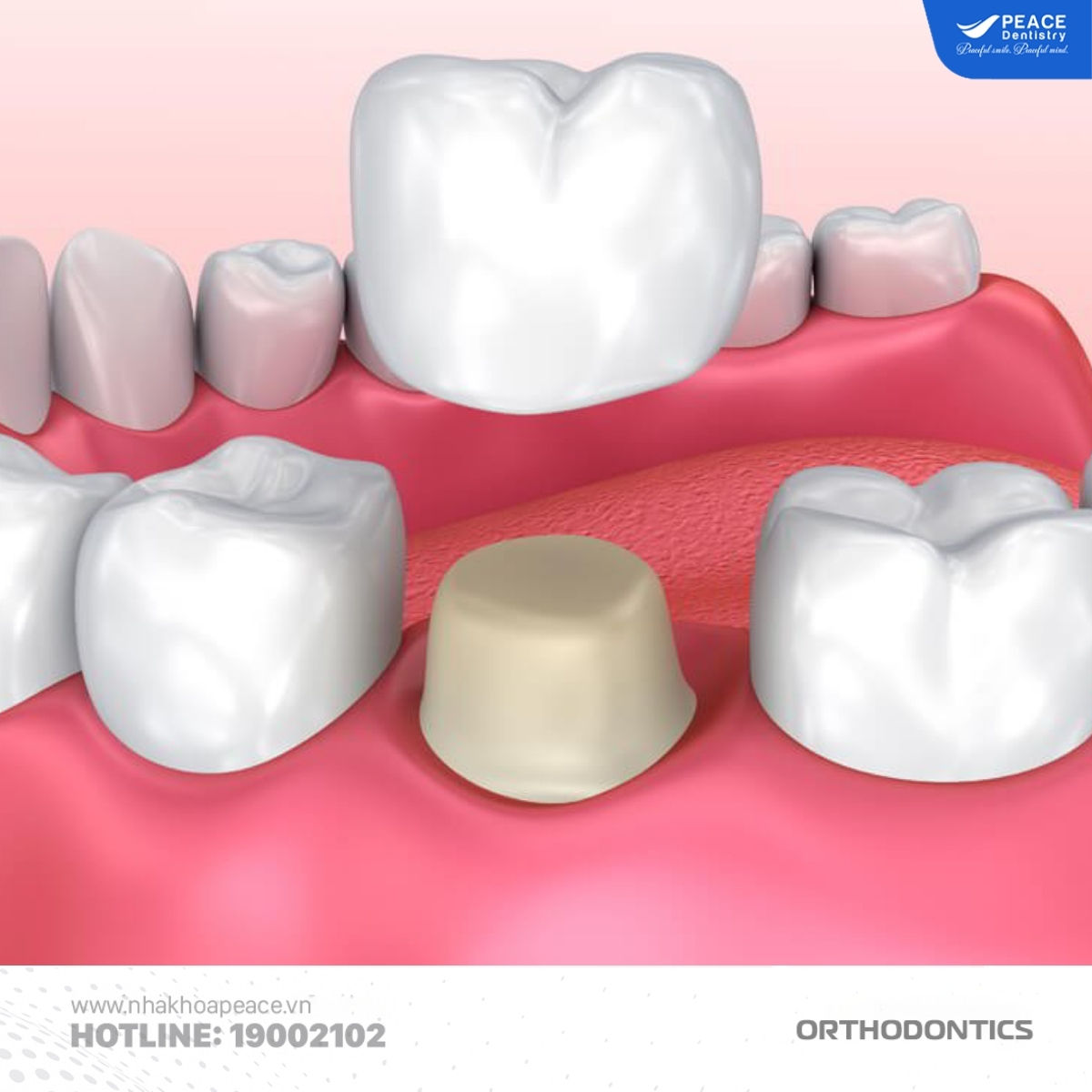 điều kiện niềng răng sau khi bọc sứ