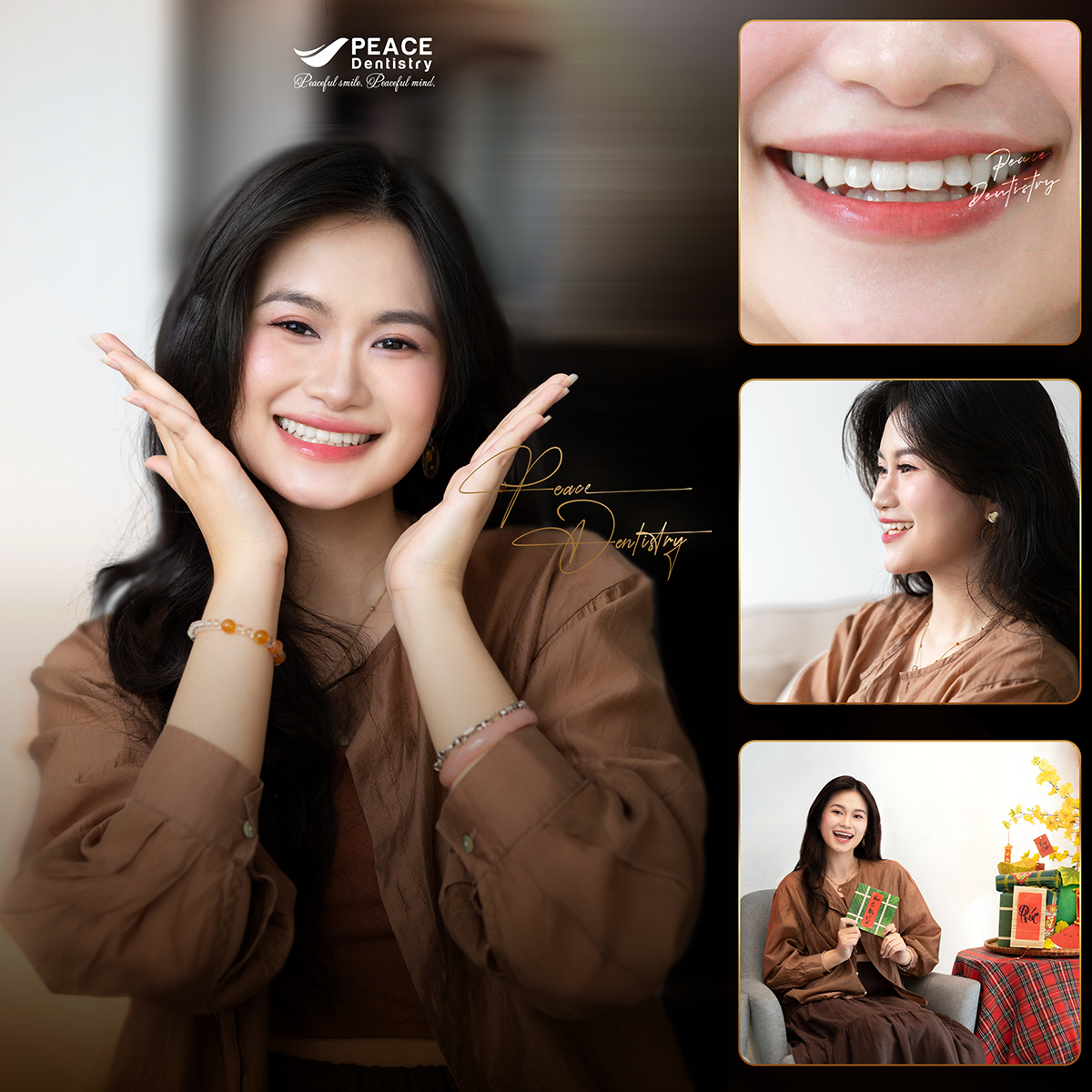 hình ảnh khách hàng hoàng quyên sau 2 năm niềng răng