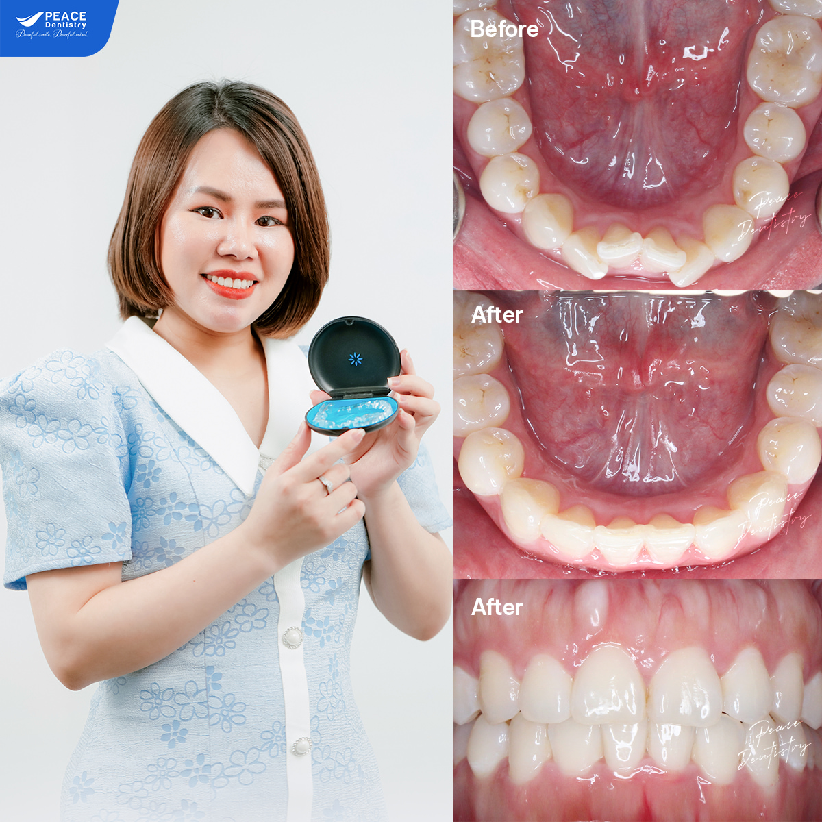 hình ảnh khách hàng vy trần sau 17 tháng niềng răng invisalign