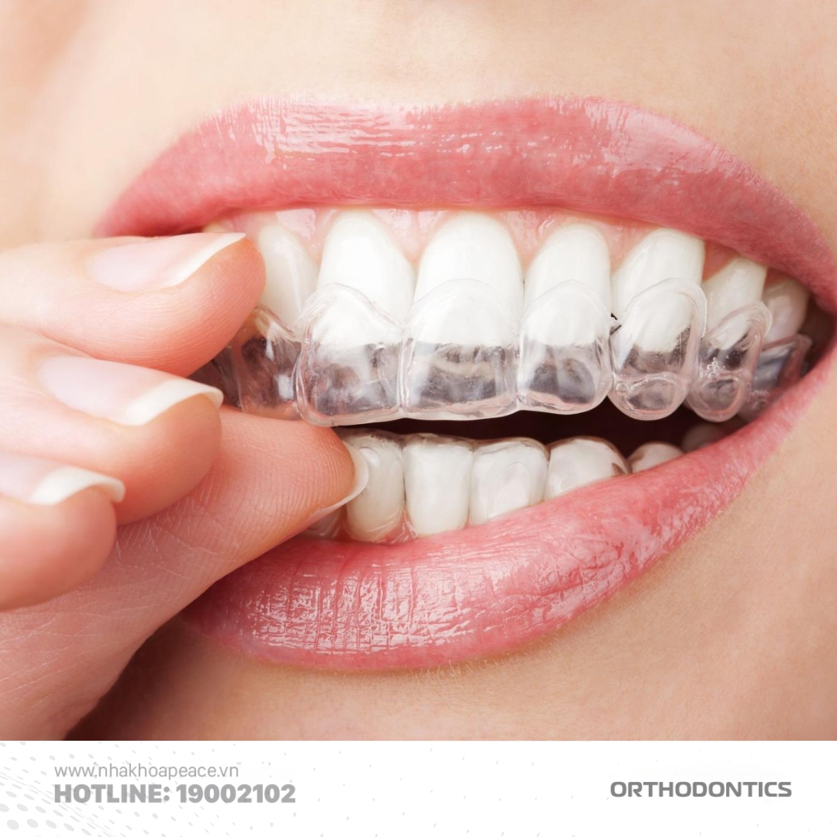lựa chọn phương pháp niềng răng phù hợp