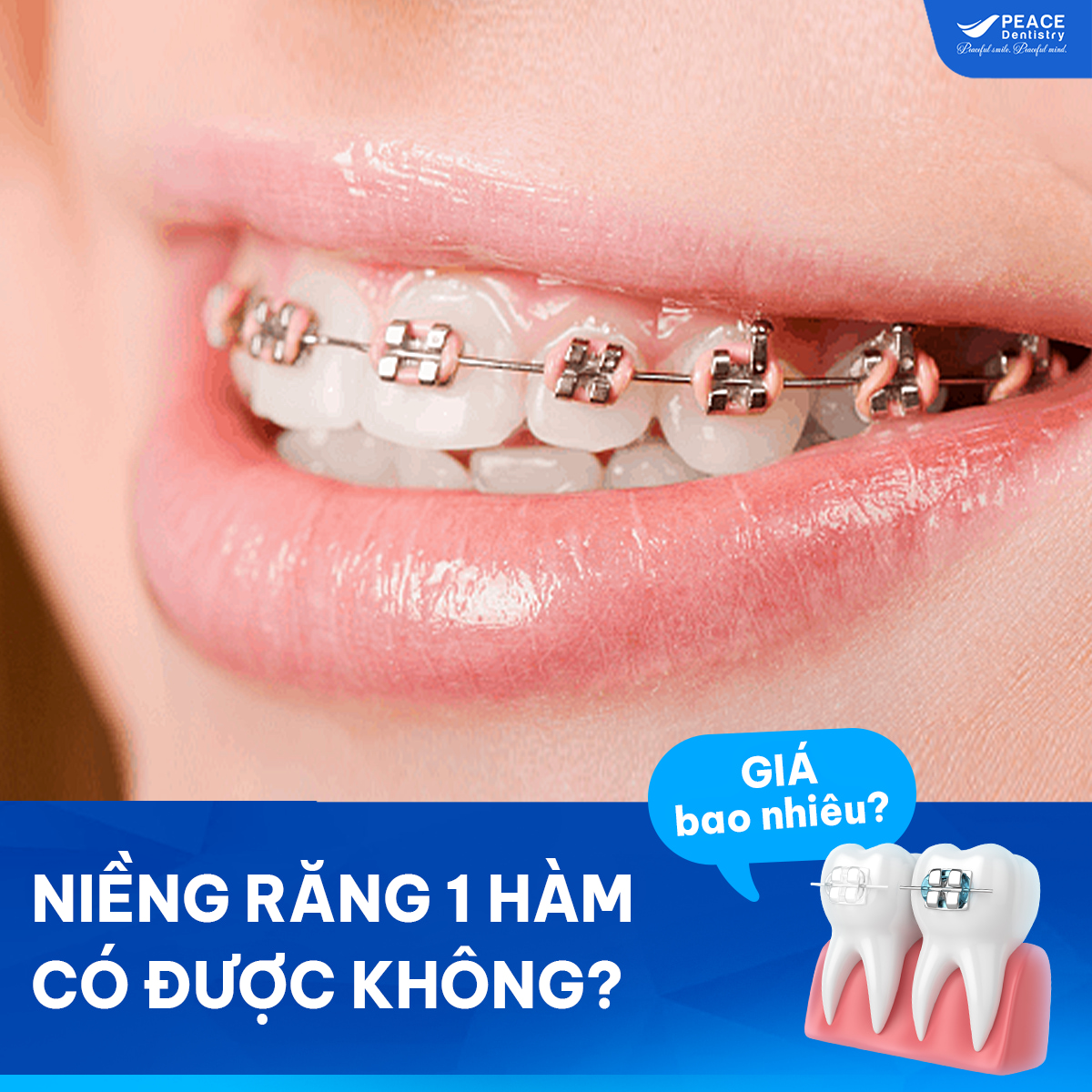 niềng răng 1 hàm