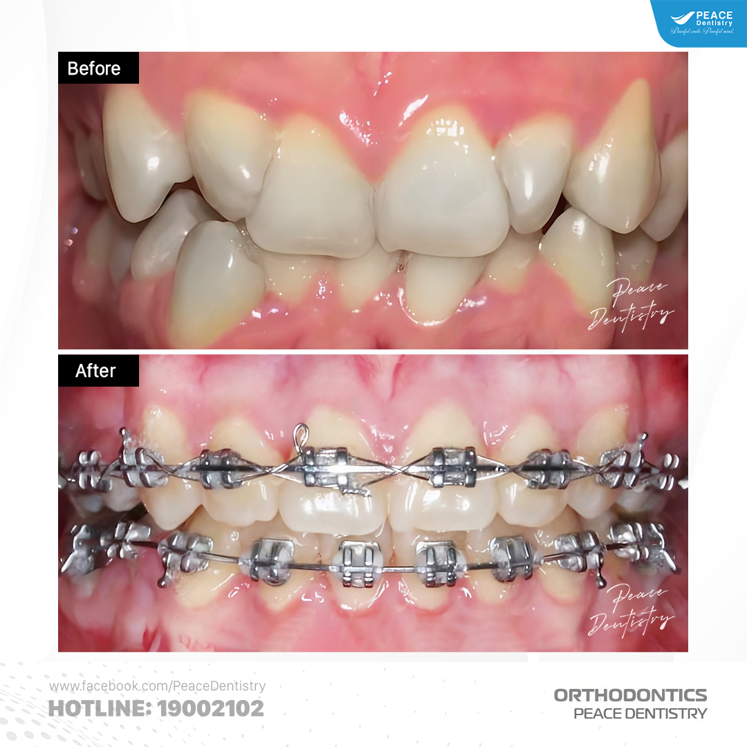 niềng răng chen chúc cho khách 22 tuổi