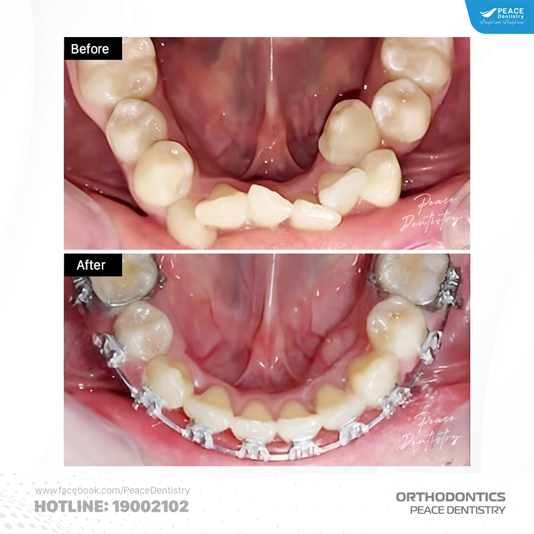 niềng răng chen chúc hẹp hàm