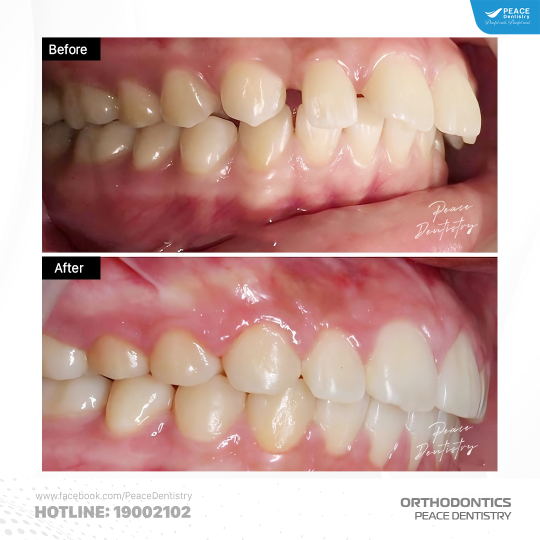 niềng răng hô thưa 14 tuổi