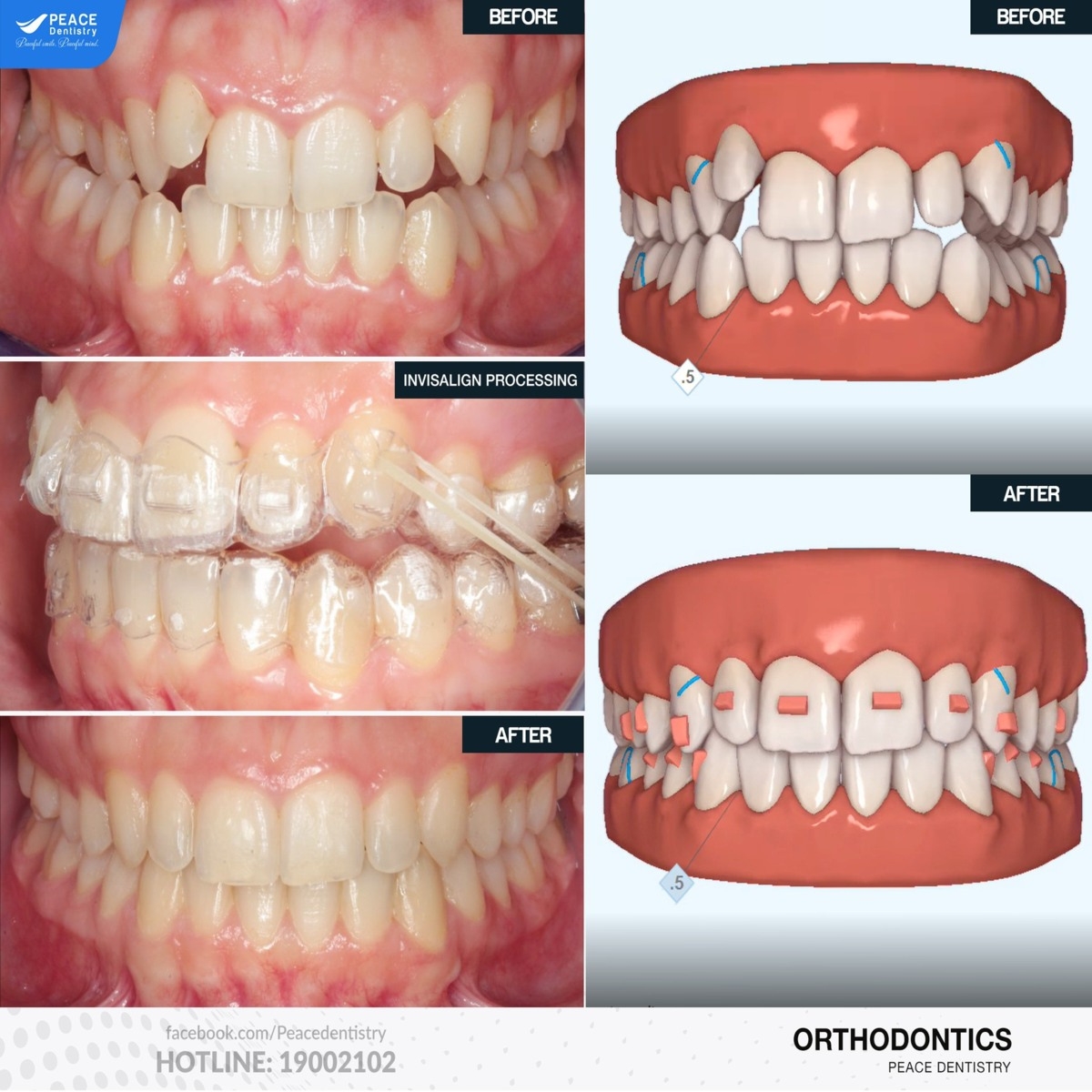 niềng răng invisalign cho khớp cắn sâu chen chúc