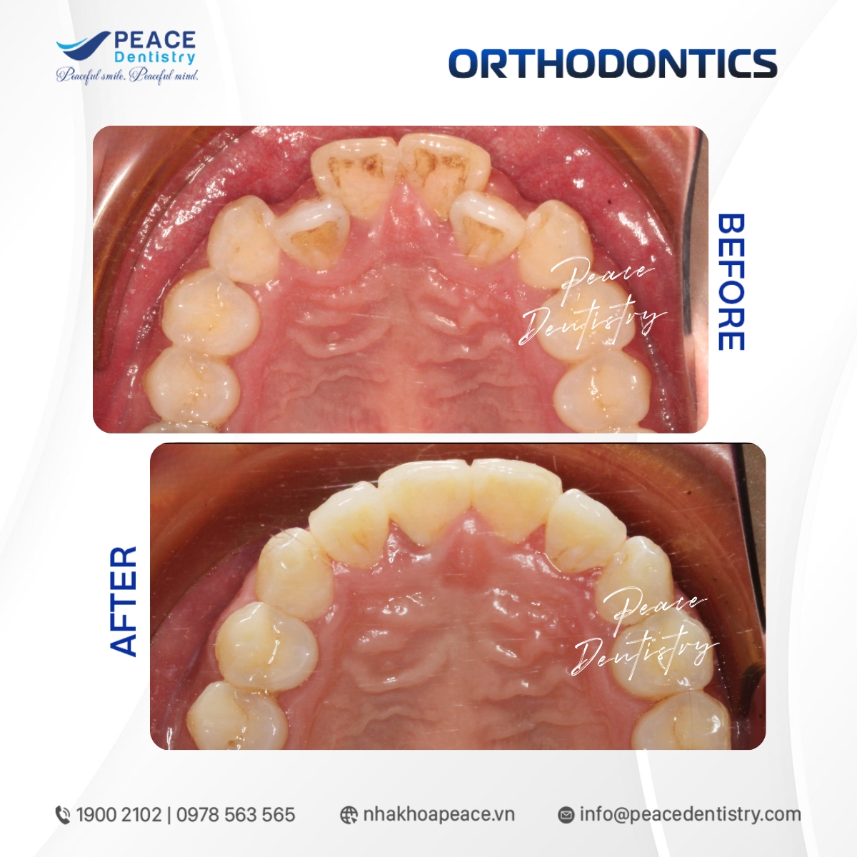 chỉ định niềng răng bằng phương pháp invisalign