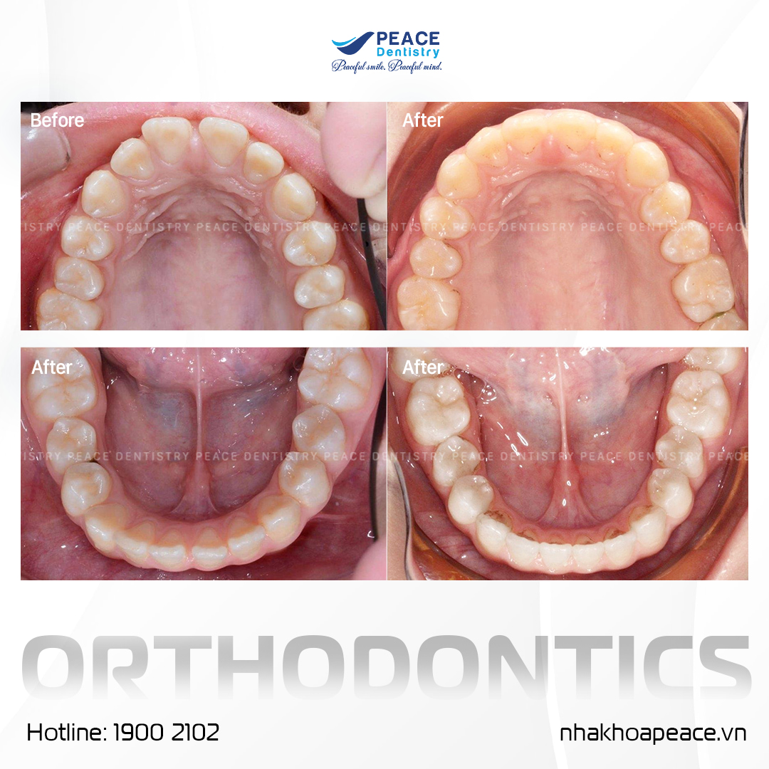 bác sĩ chỉ định niềng răng invisalign