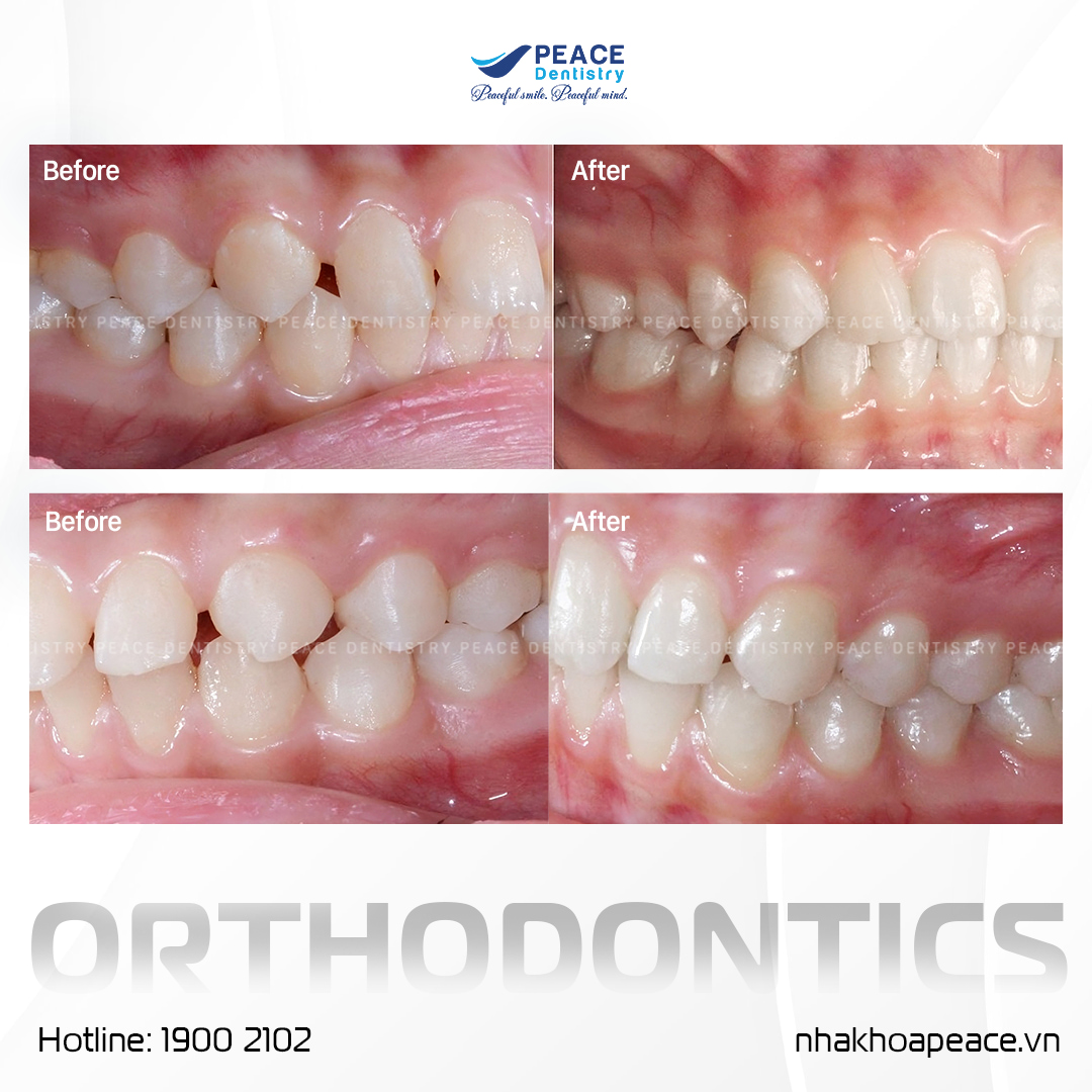 răng được cải thiện rõ rệt sau khi niềng