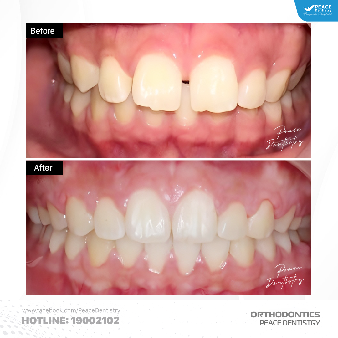 niềng răng thưa 1 hàm trong 20 tháng