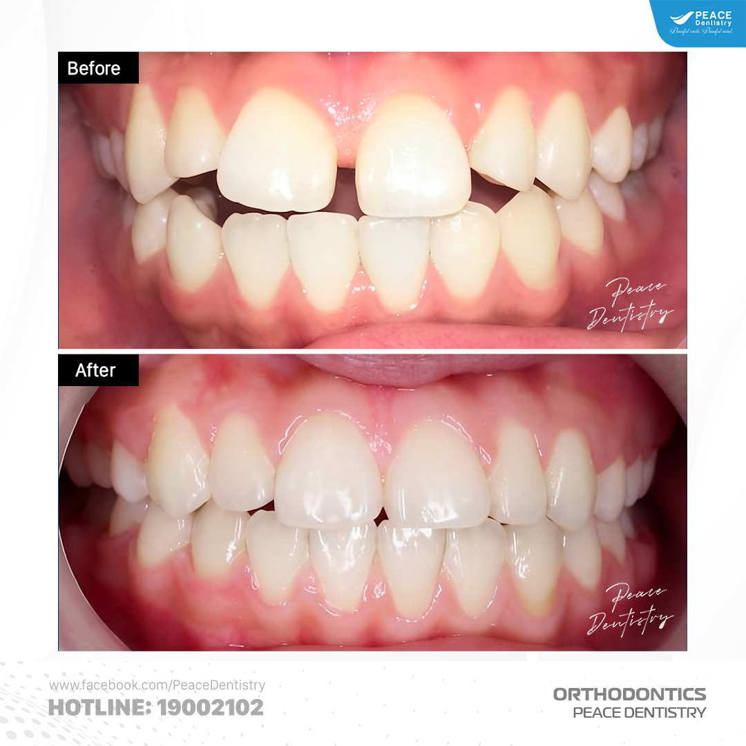niềng răng thưa hàm trên trong 20 tháng giá 15 triệu
