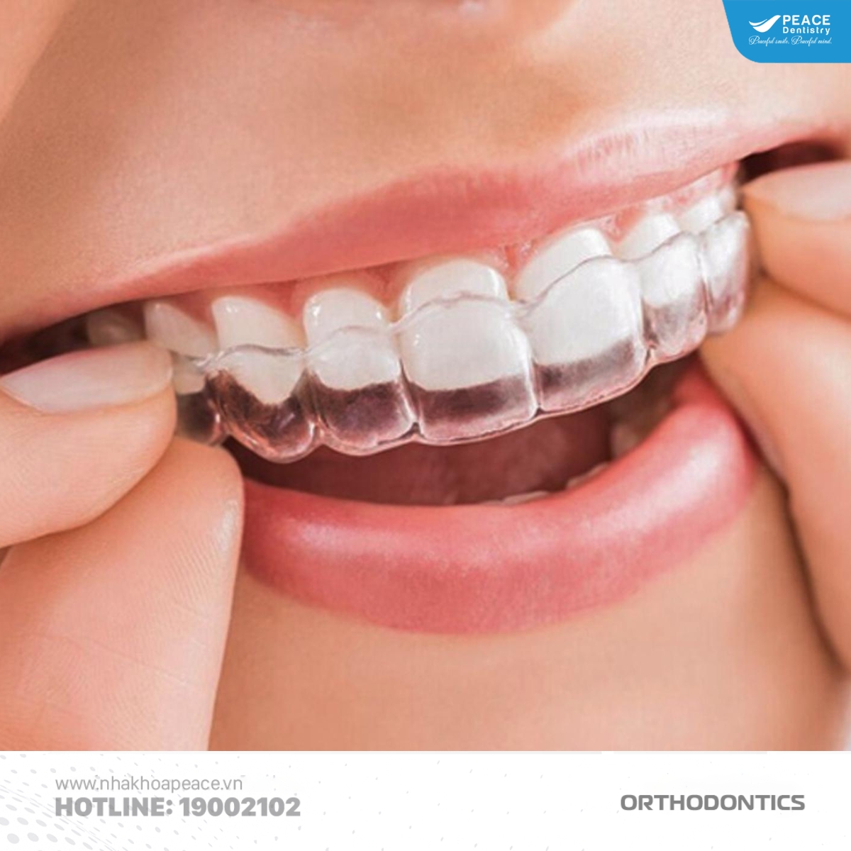 niềng răng trong suốt invisalign không cần siết răng