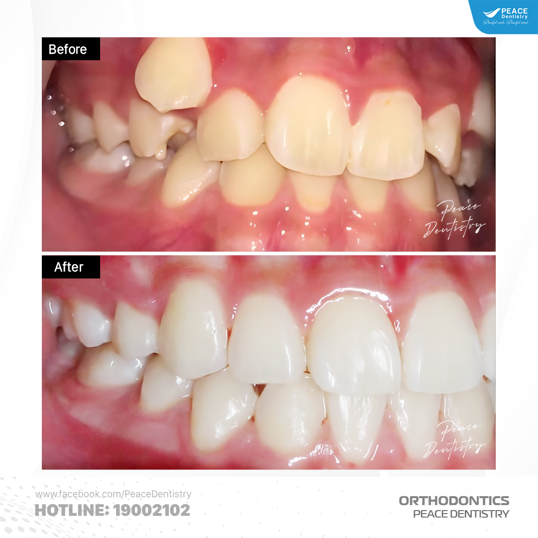 niềng răng xô lệch cho khách trên 30 tuổi