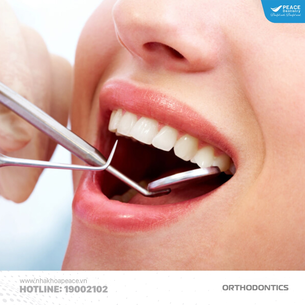 niềng răng xong bị móm nguyên nhân do đâu