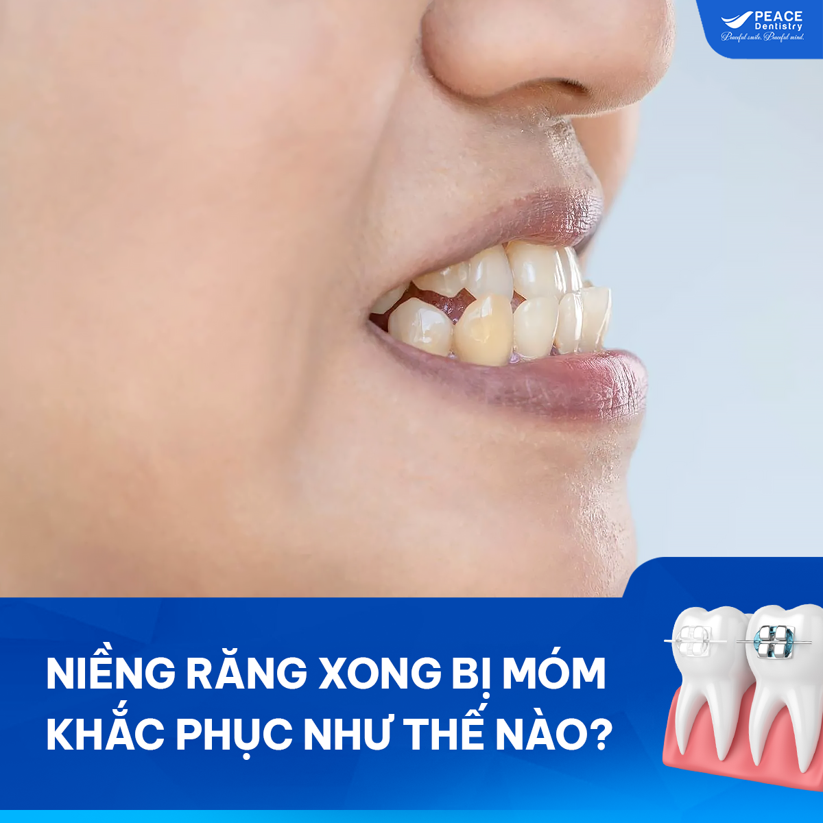 niềng răng xong bị móm