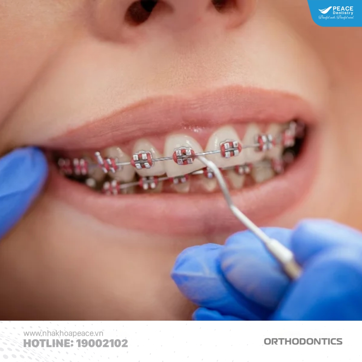 siết răng khi niềng mất bao lâu