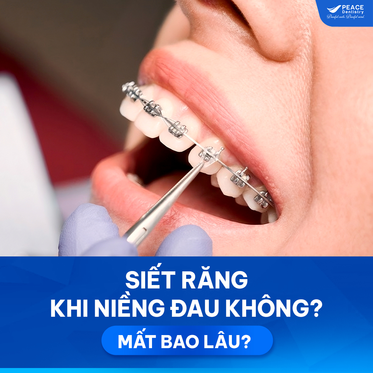 siết răng khi niềng