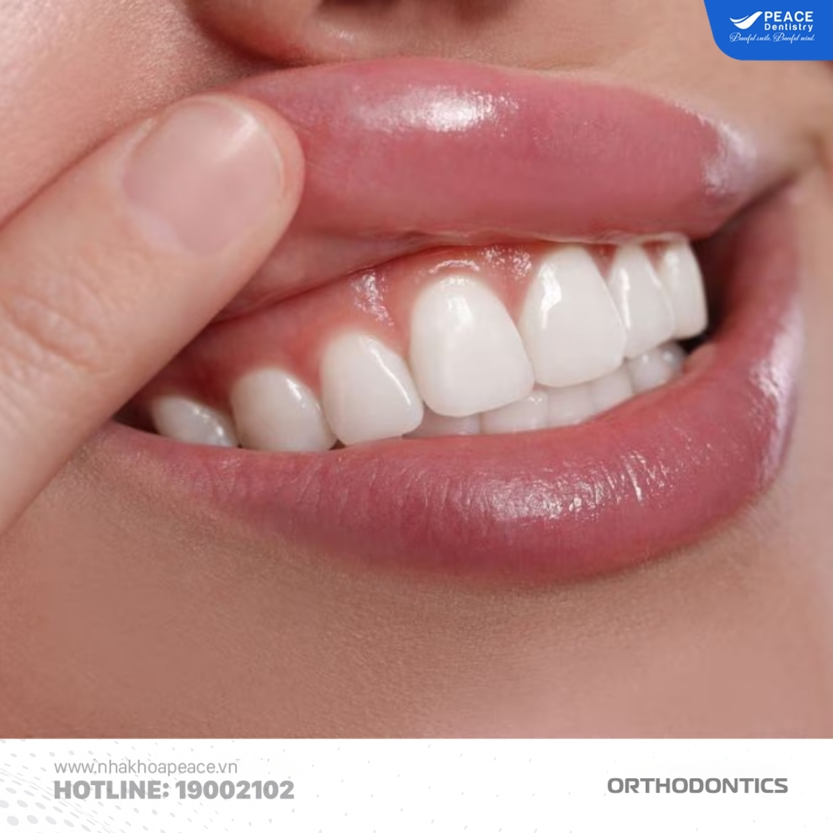 trường hợp được niềng răng sau khi bọc sứ
