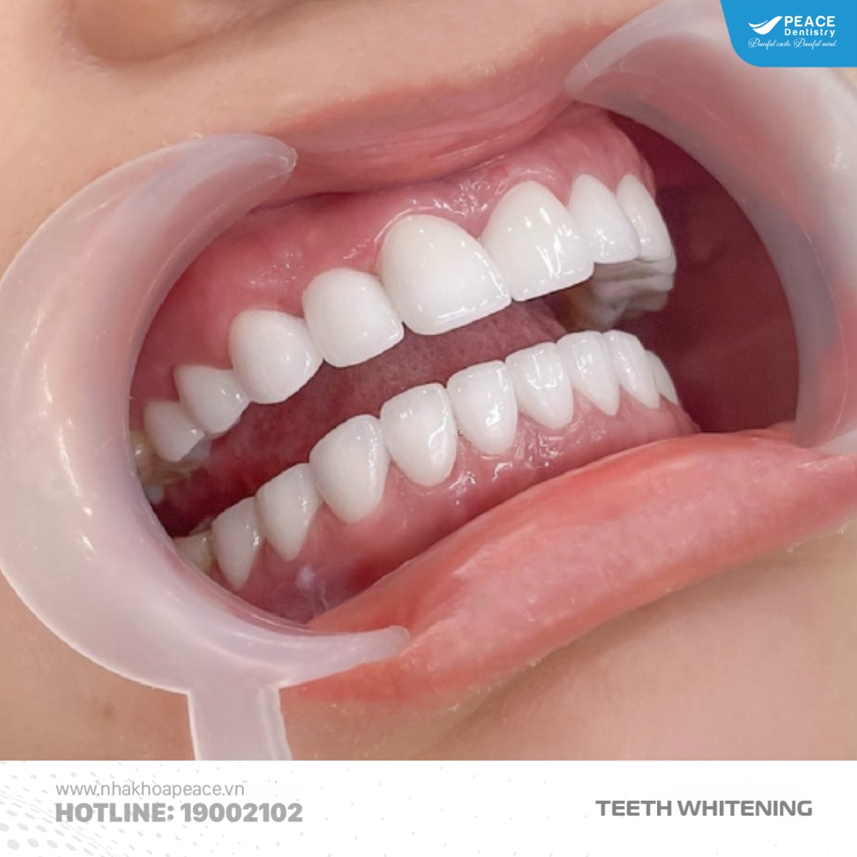 trường hợp không nên tẩy trắng răng