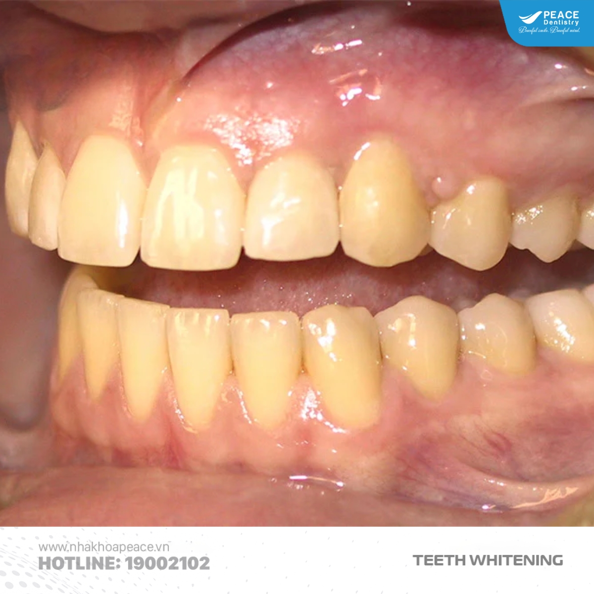 trường hợp nên tẩy trắng răng