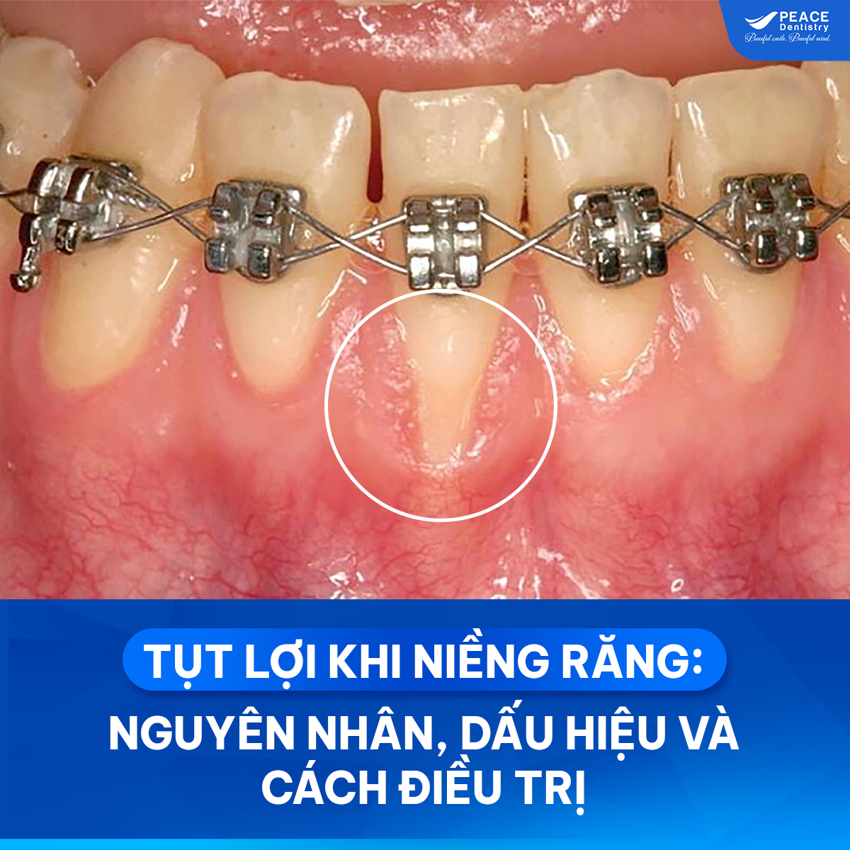 tụt lợi khi niềng răng