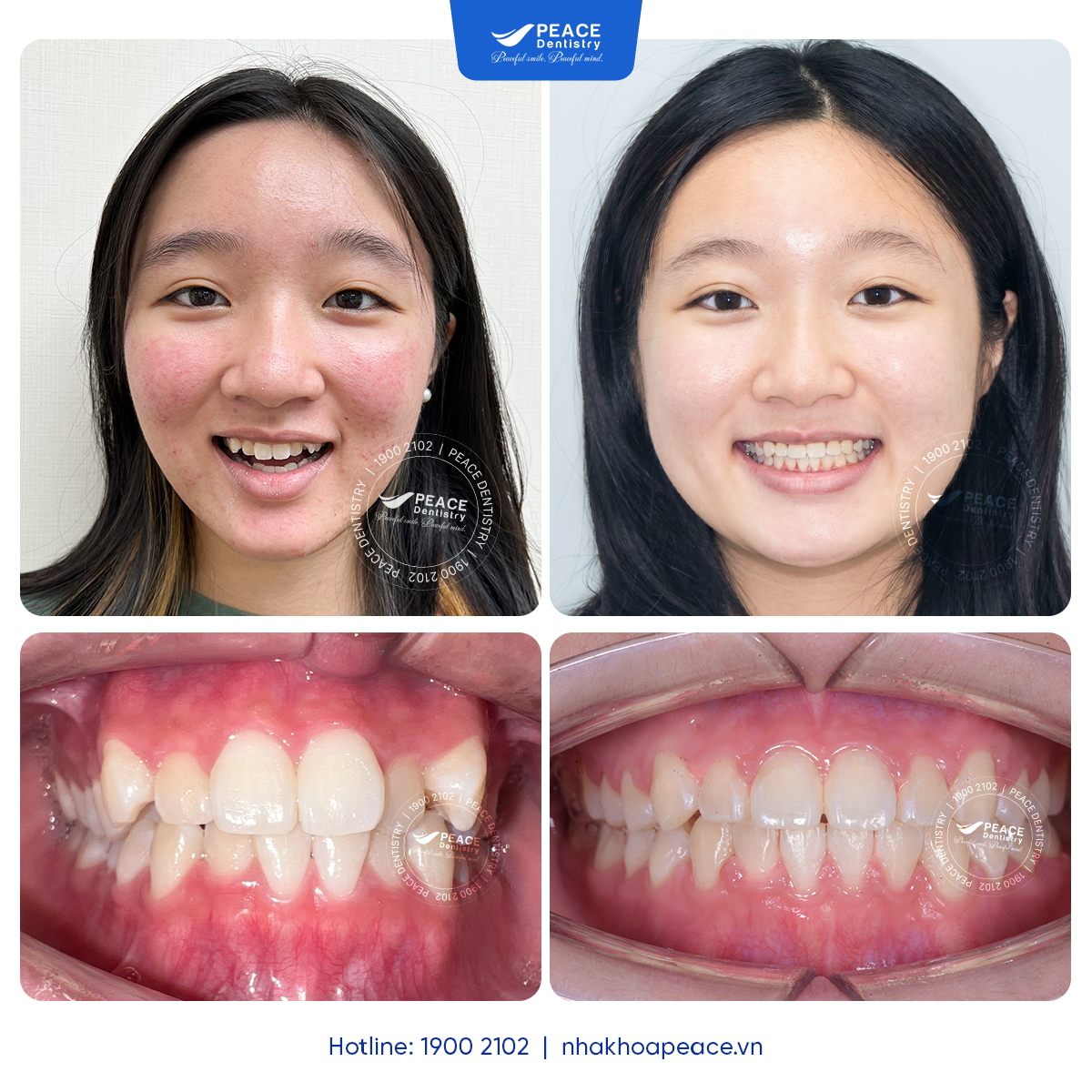 case niềng răng chen chúc