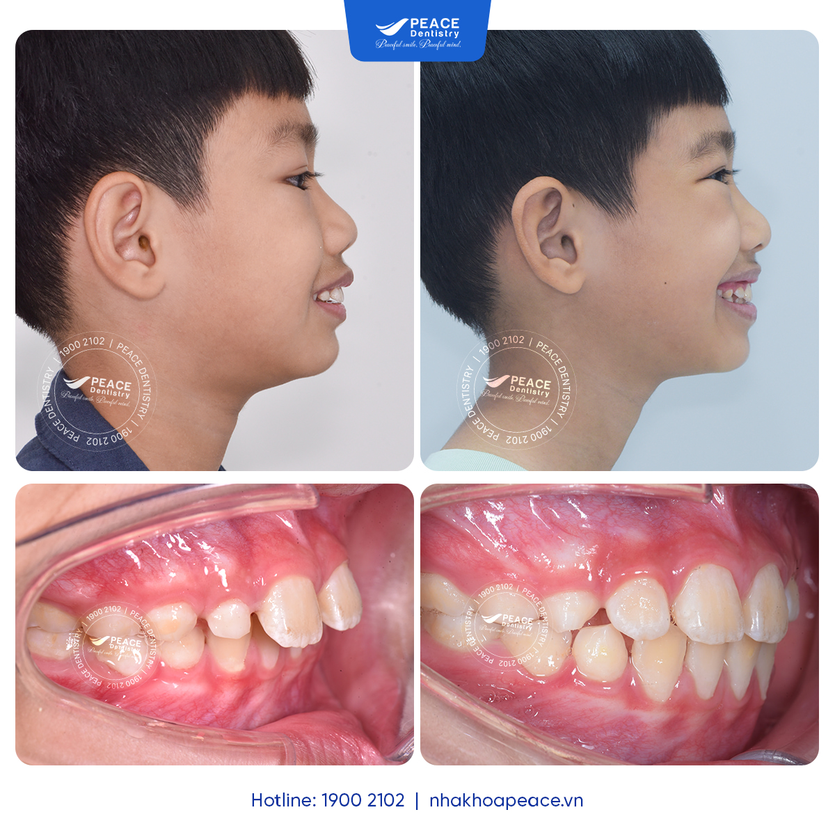 case niềng răng hô nhẹ