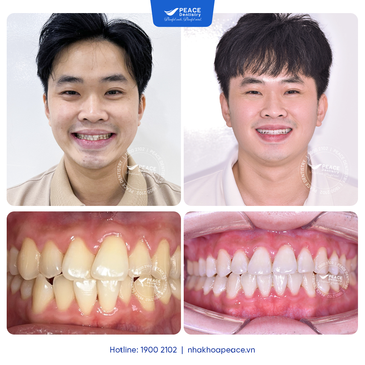 niềng răng 12 tháng cải thiện tình trạng cắn chéo case huỳnh luân