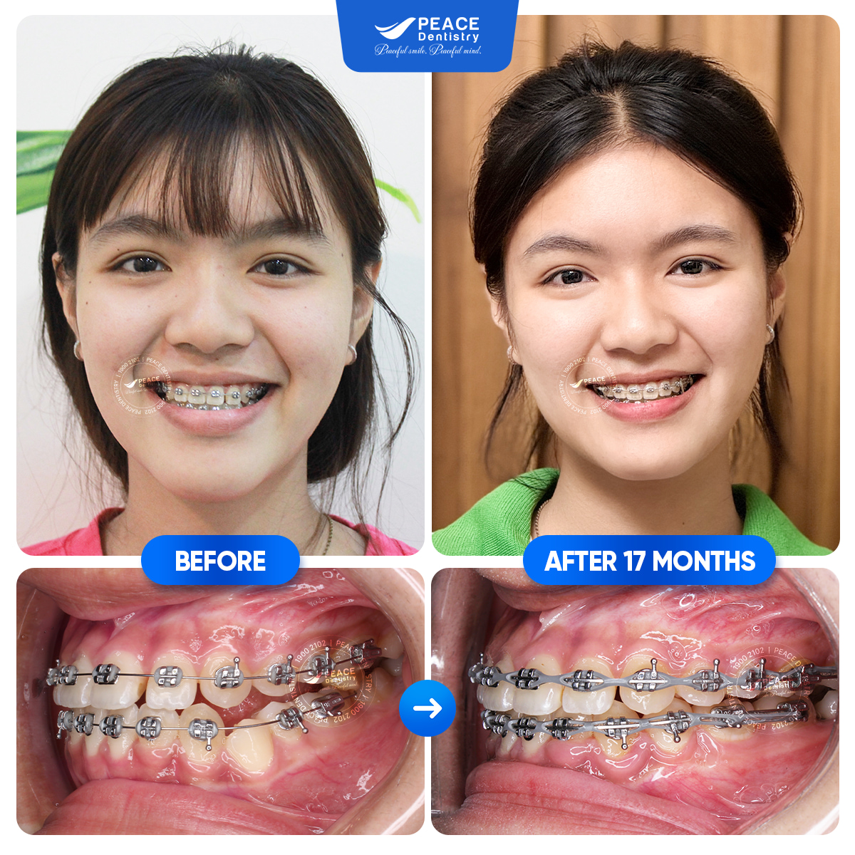 hình ảnh khách hàng nhã kỳ sau khi niềng răng