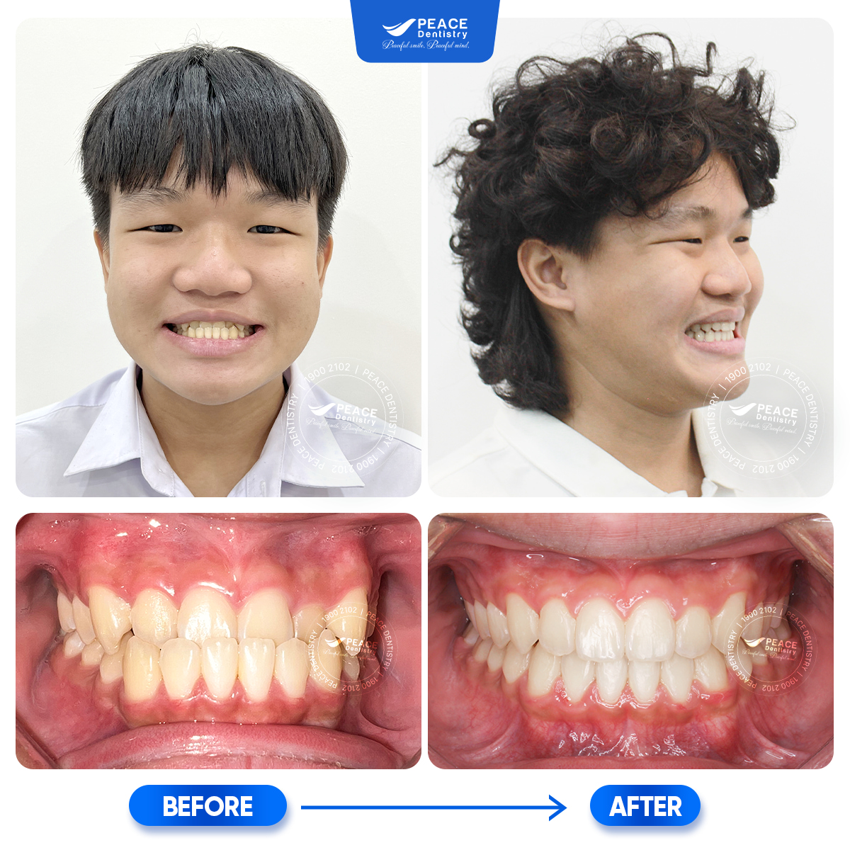 hình ảnh khách hàng sau 18 tháng niềng răng