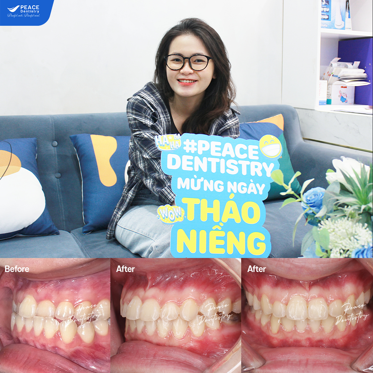 hình ảnh khách hàng xuân mai sau khi niềng răng