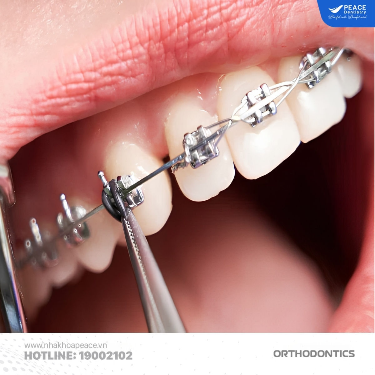 niềng răng mùa hè dễ làm quen với khí cụ