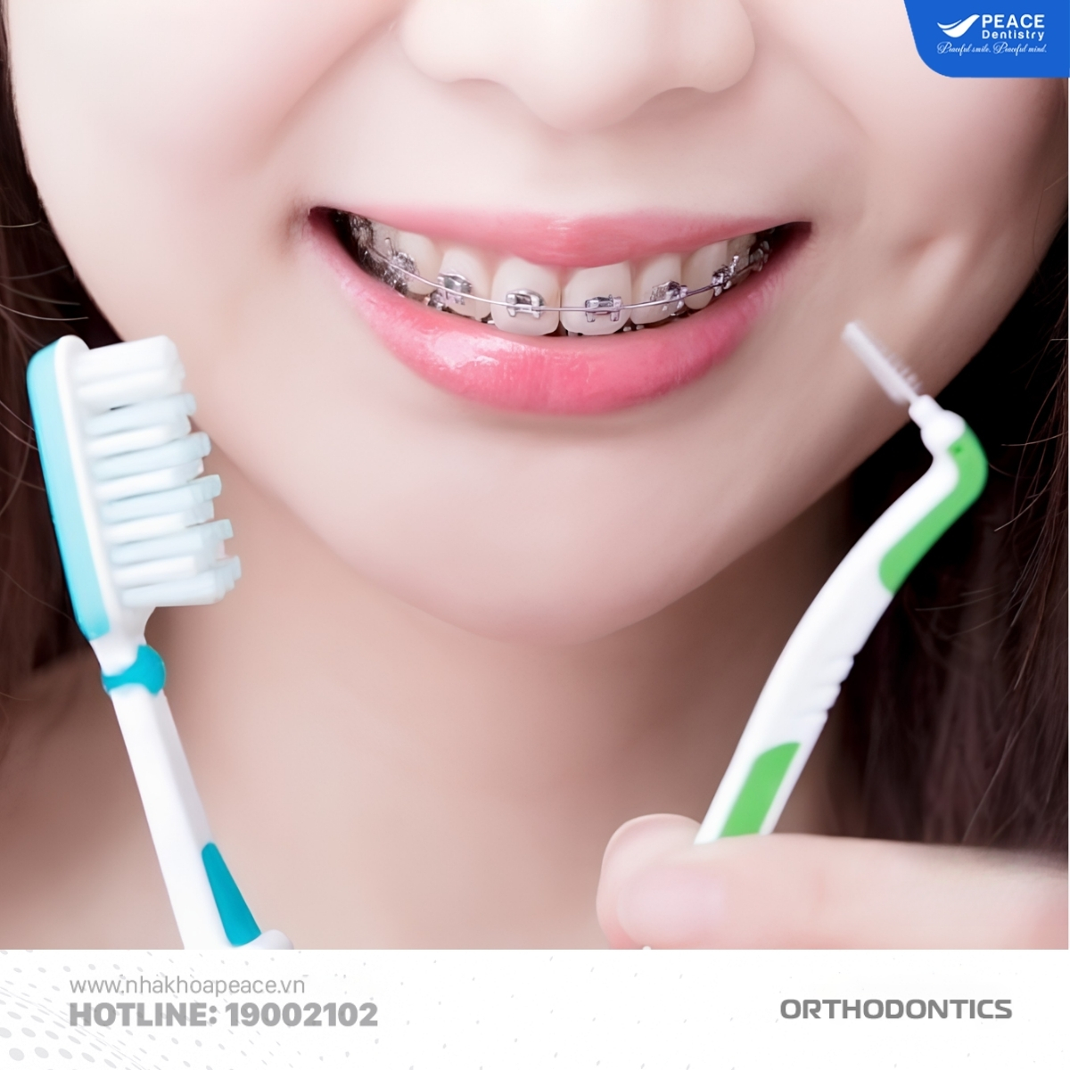 niềng răng mùa hè thích nghi với việc chăm sóc