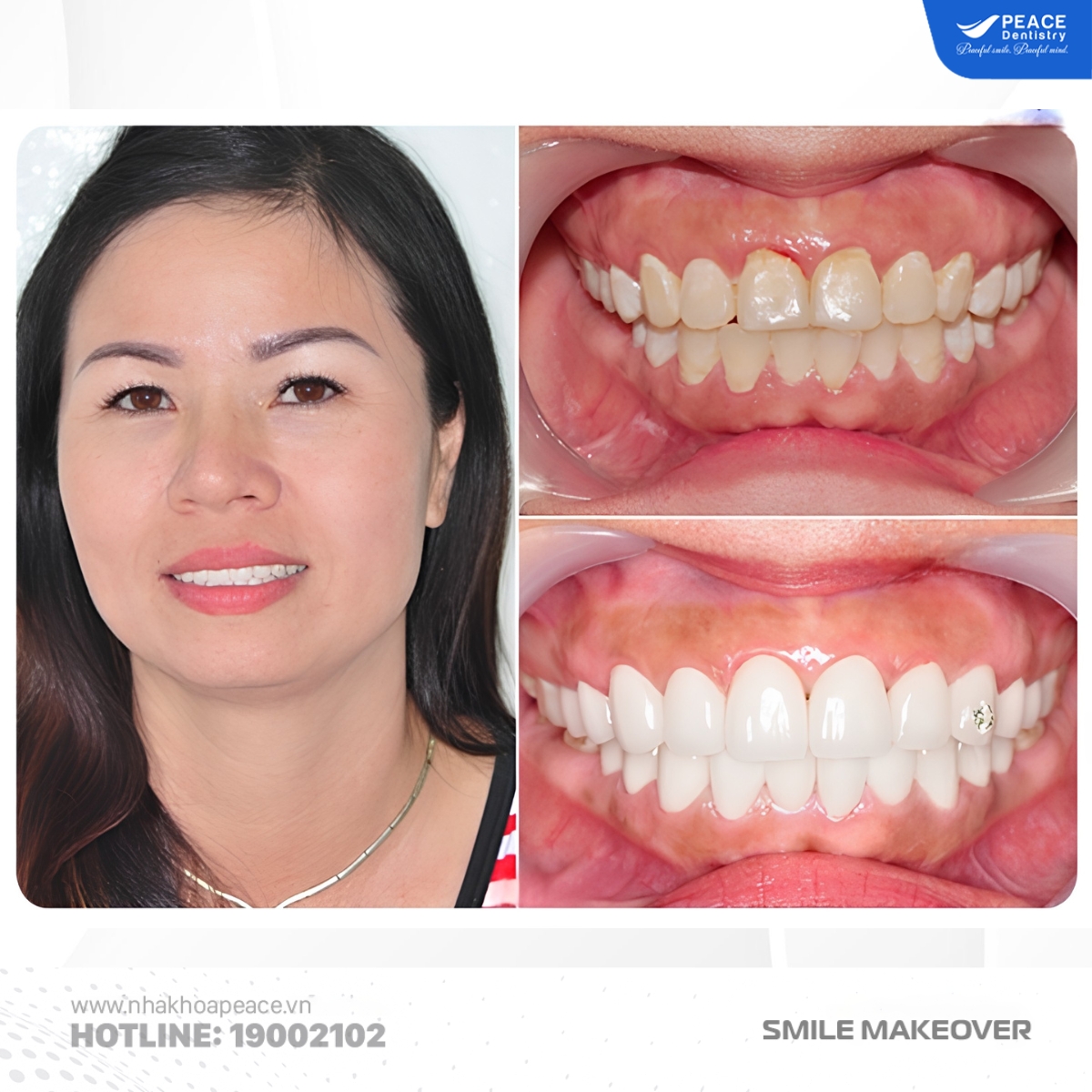 thẩm mỹ răng sứ phong cách châu âu