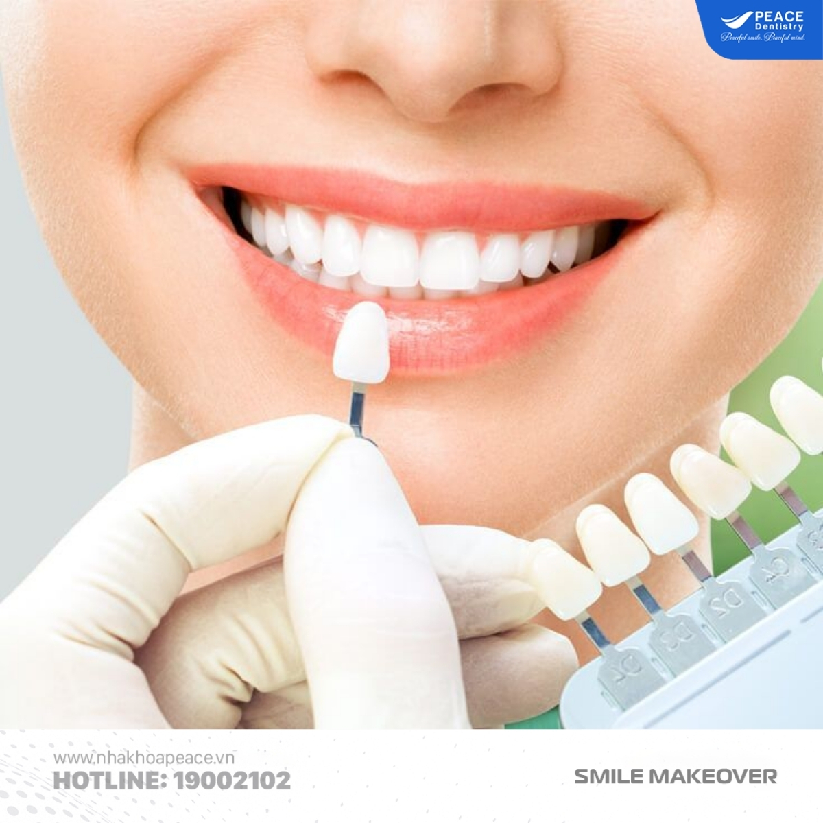 thẩm mỹ răng sứ phong cách hoa hậu