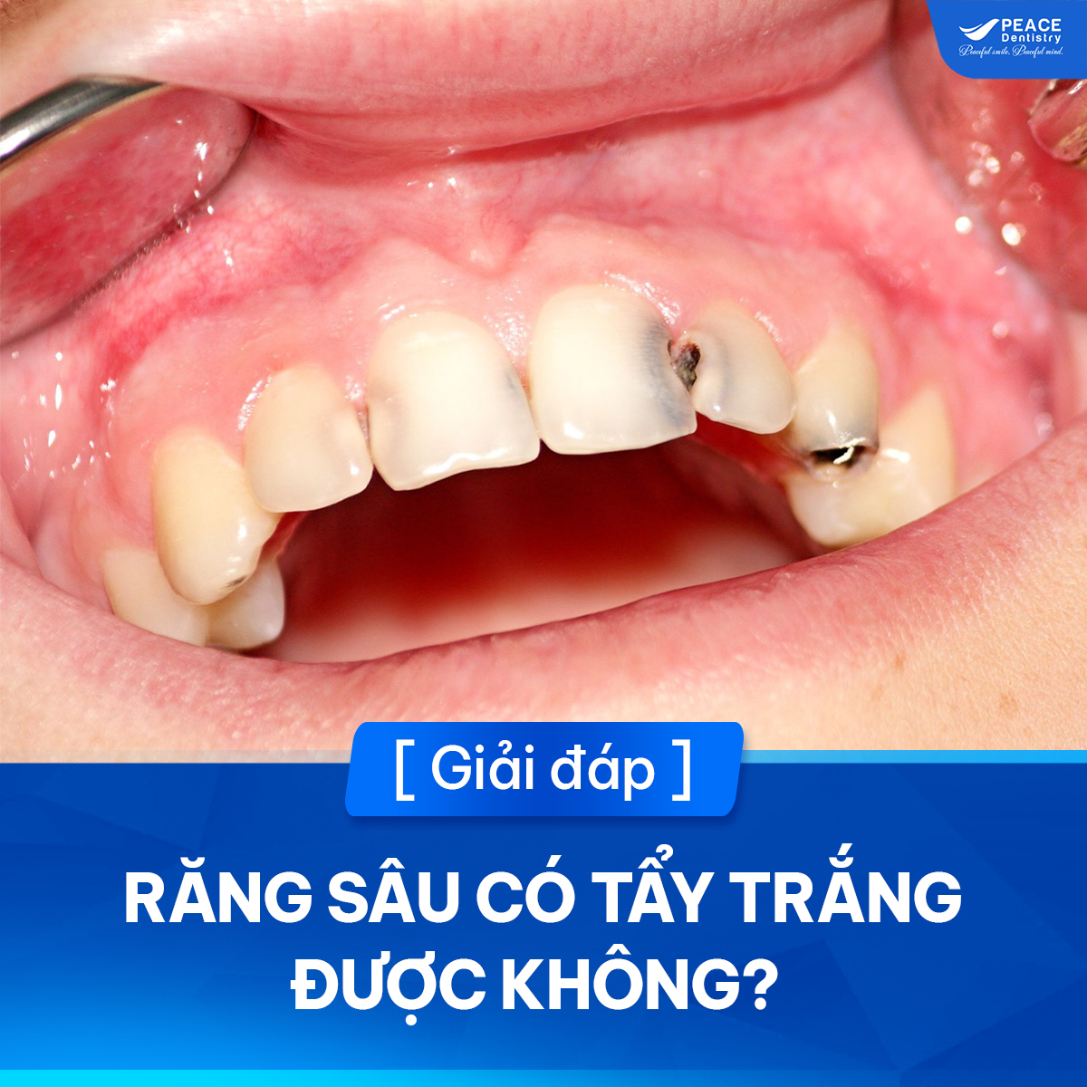 răng sâu có tẩy trắng được không