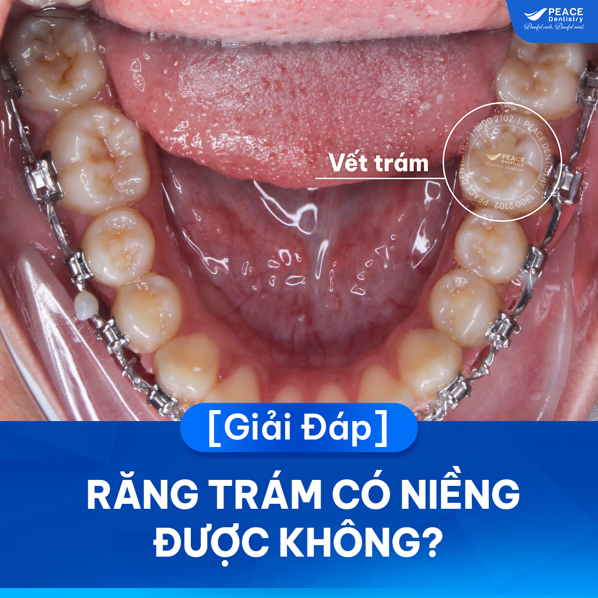 răng trám có niềng được không