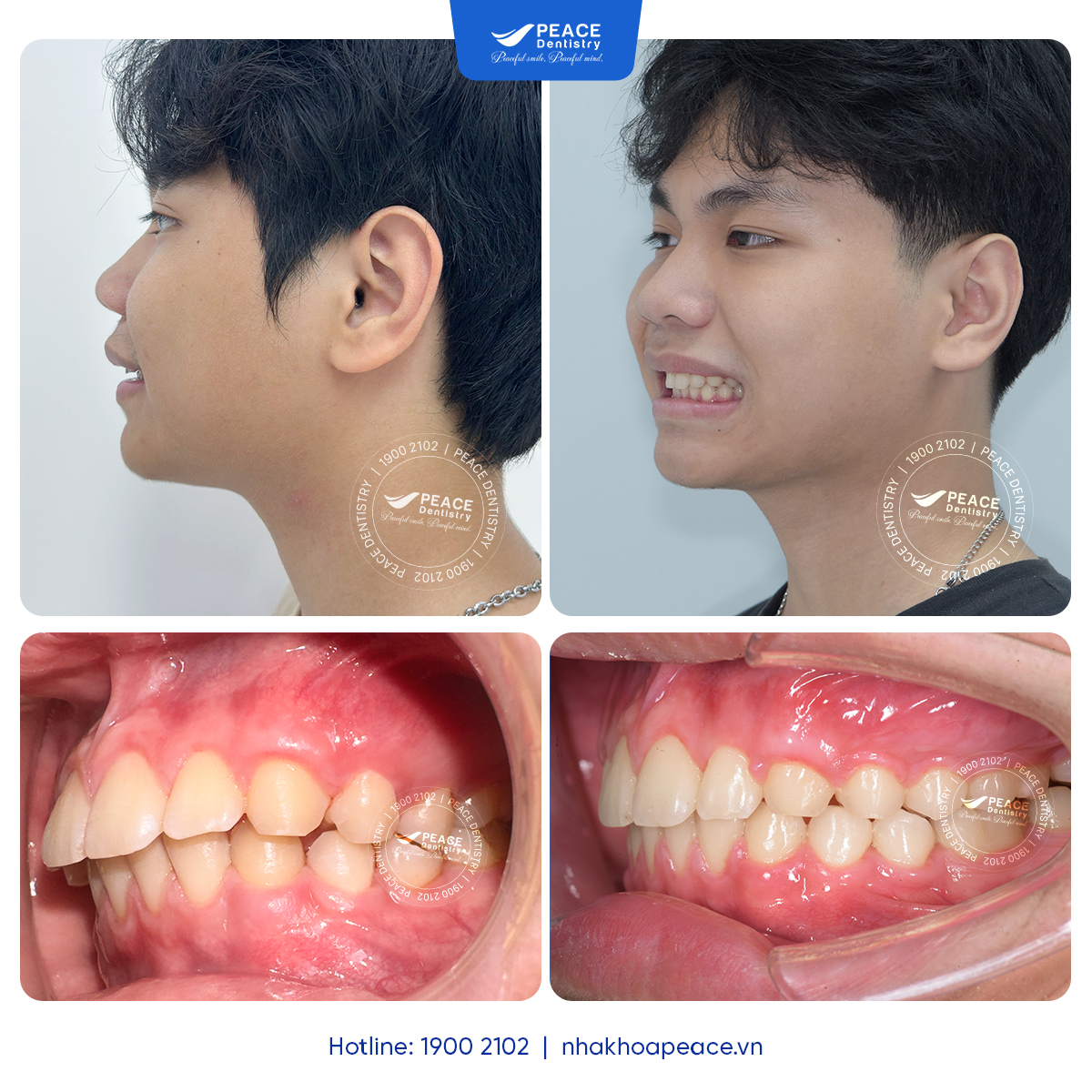 sau 1 năm niềng răng cải thiện tình trạng răng hô lệch lạc