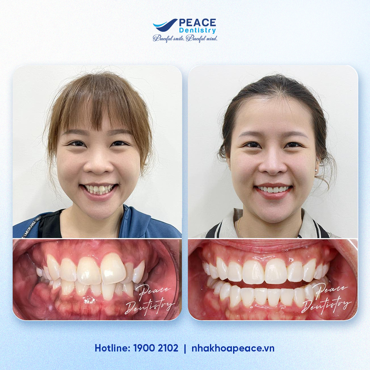 sau khi niềng răng khớp cắn chuẩn